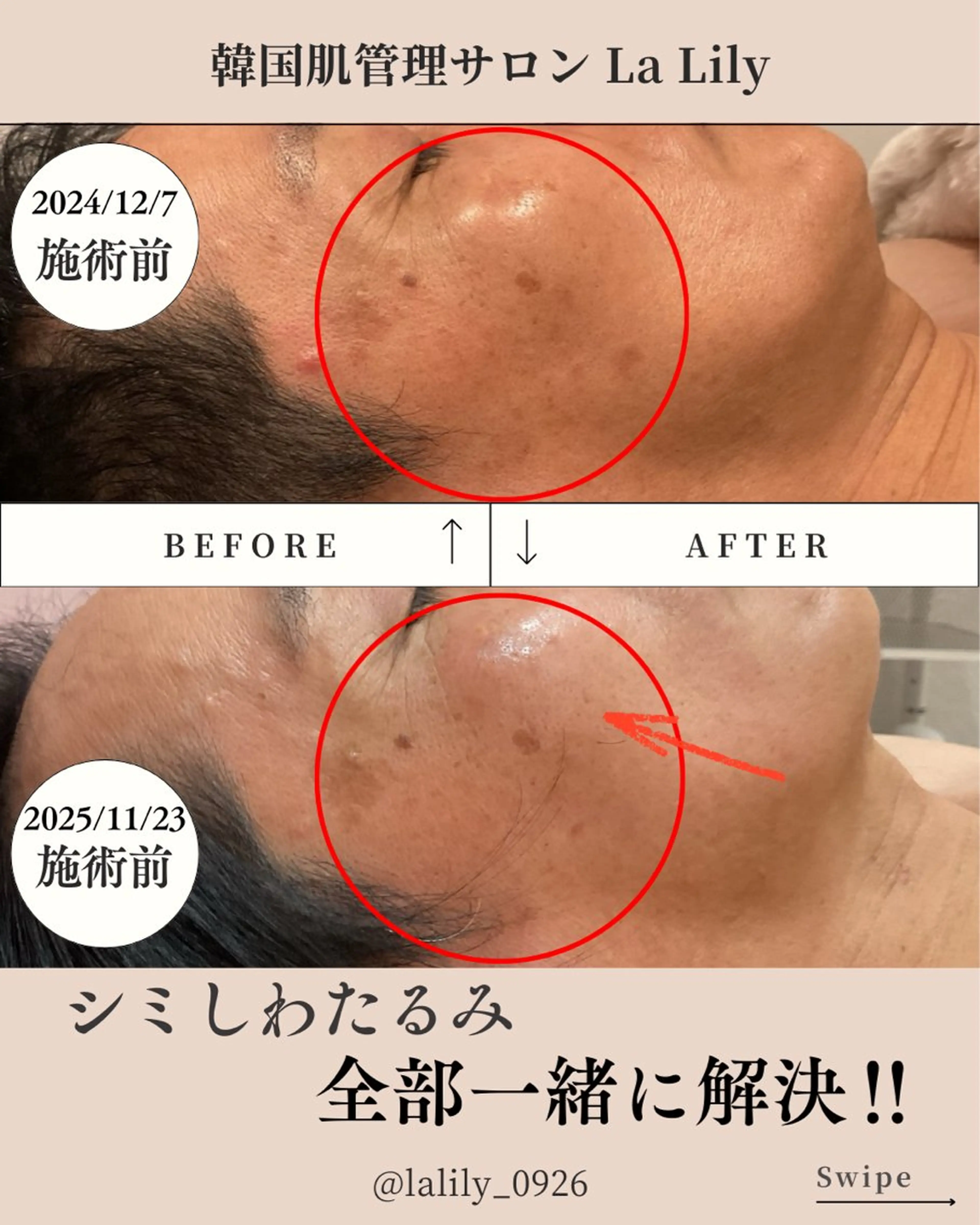 韓国式無針水光施術ミコステラ+毛穴洗浄の写真