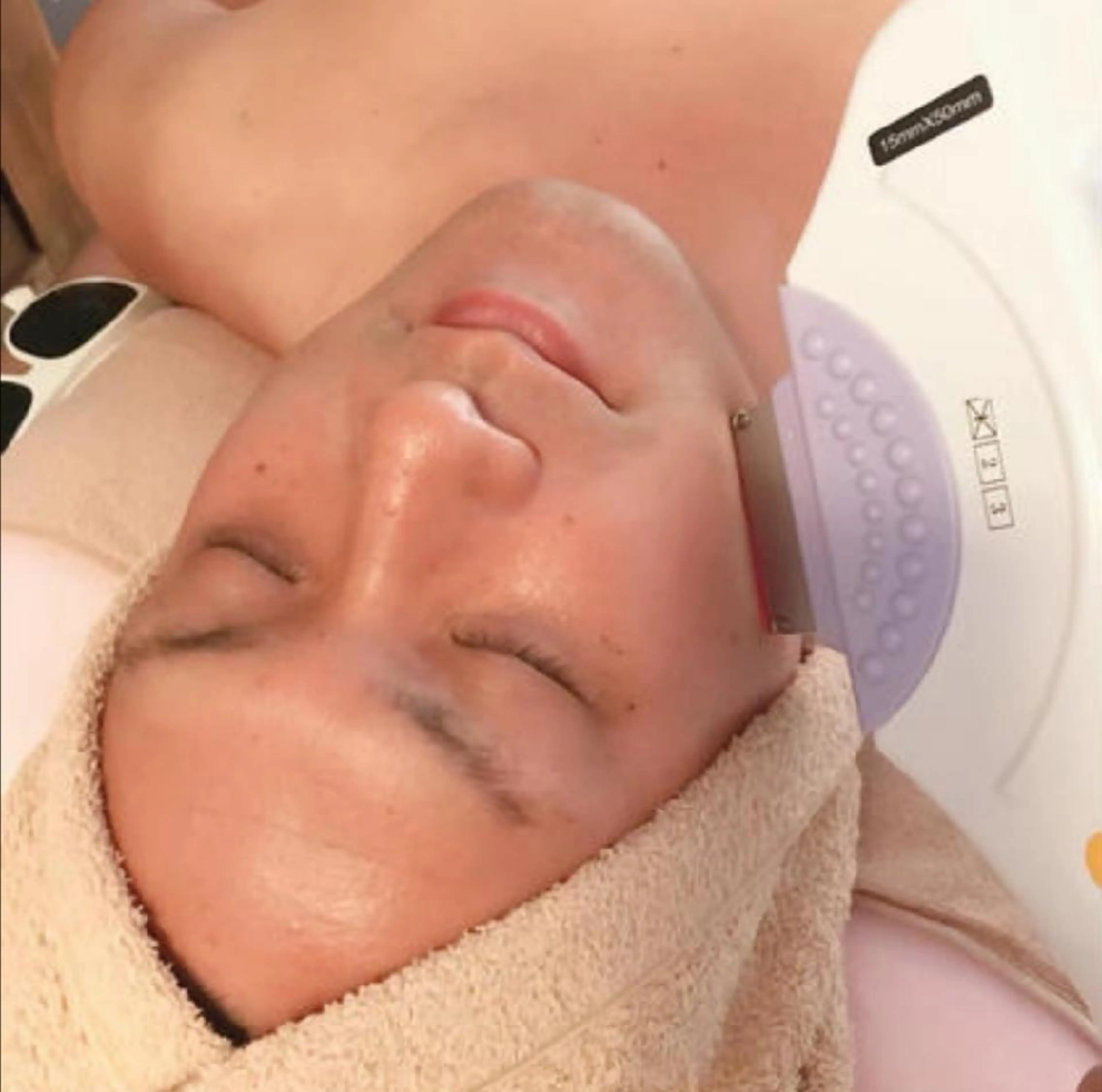 メンズひげ脱毛の写真