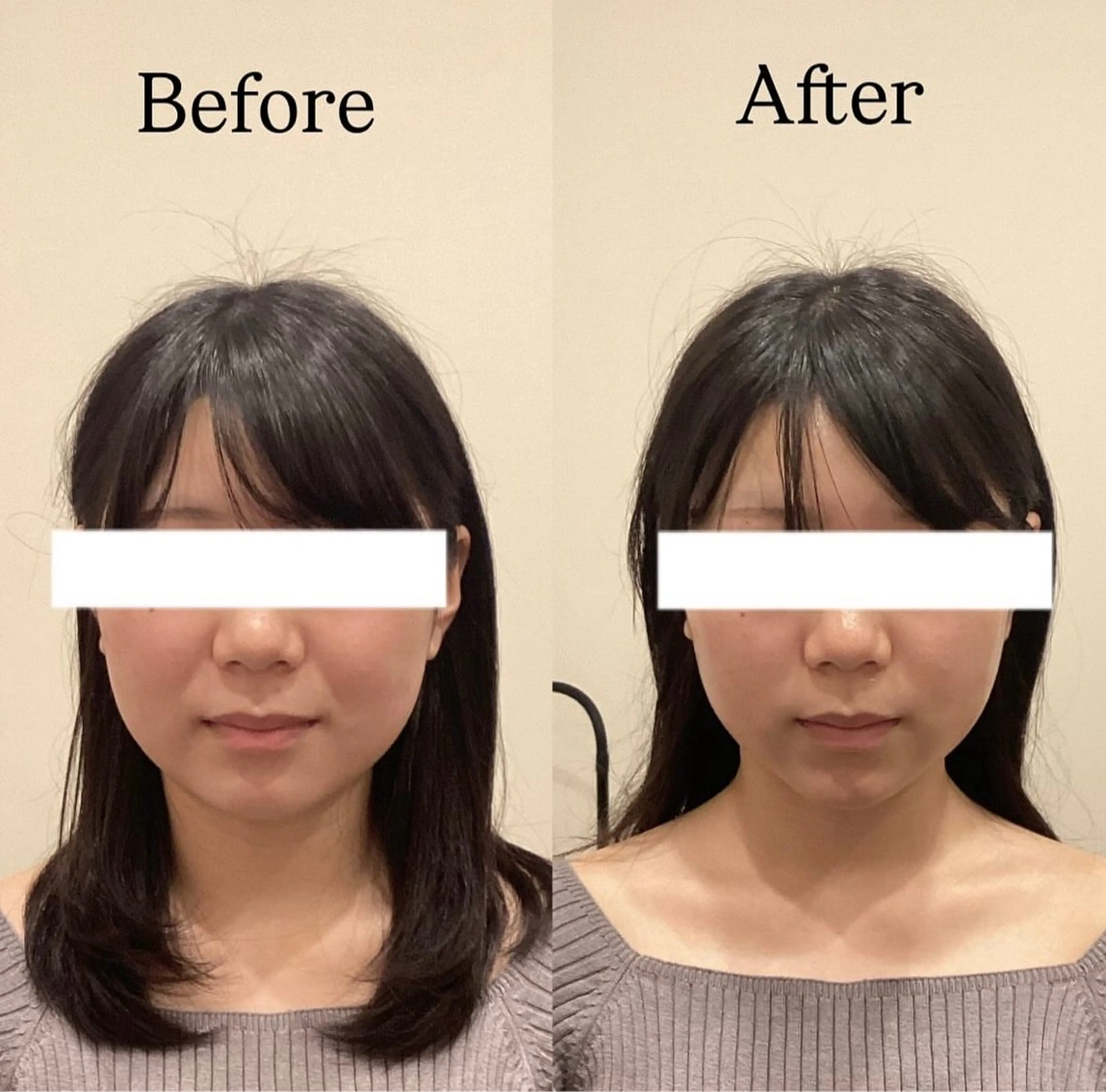 🔰basic美容鍼(50本)🪡の写真