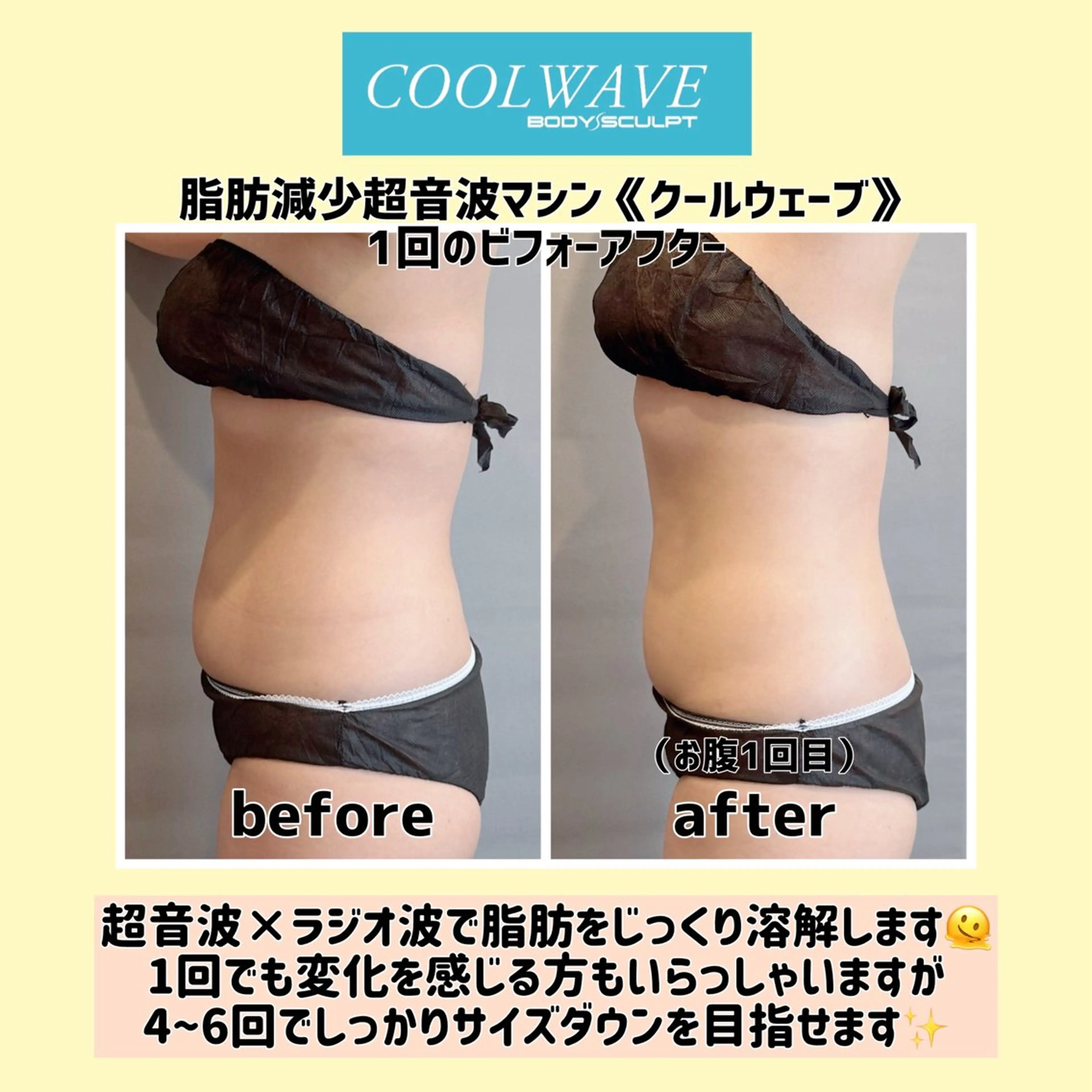 脂肪減少超音波マシン《クールウェーブ》の写真