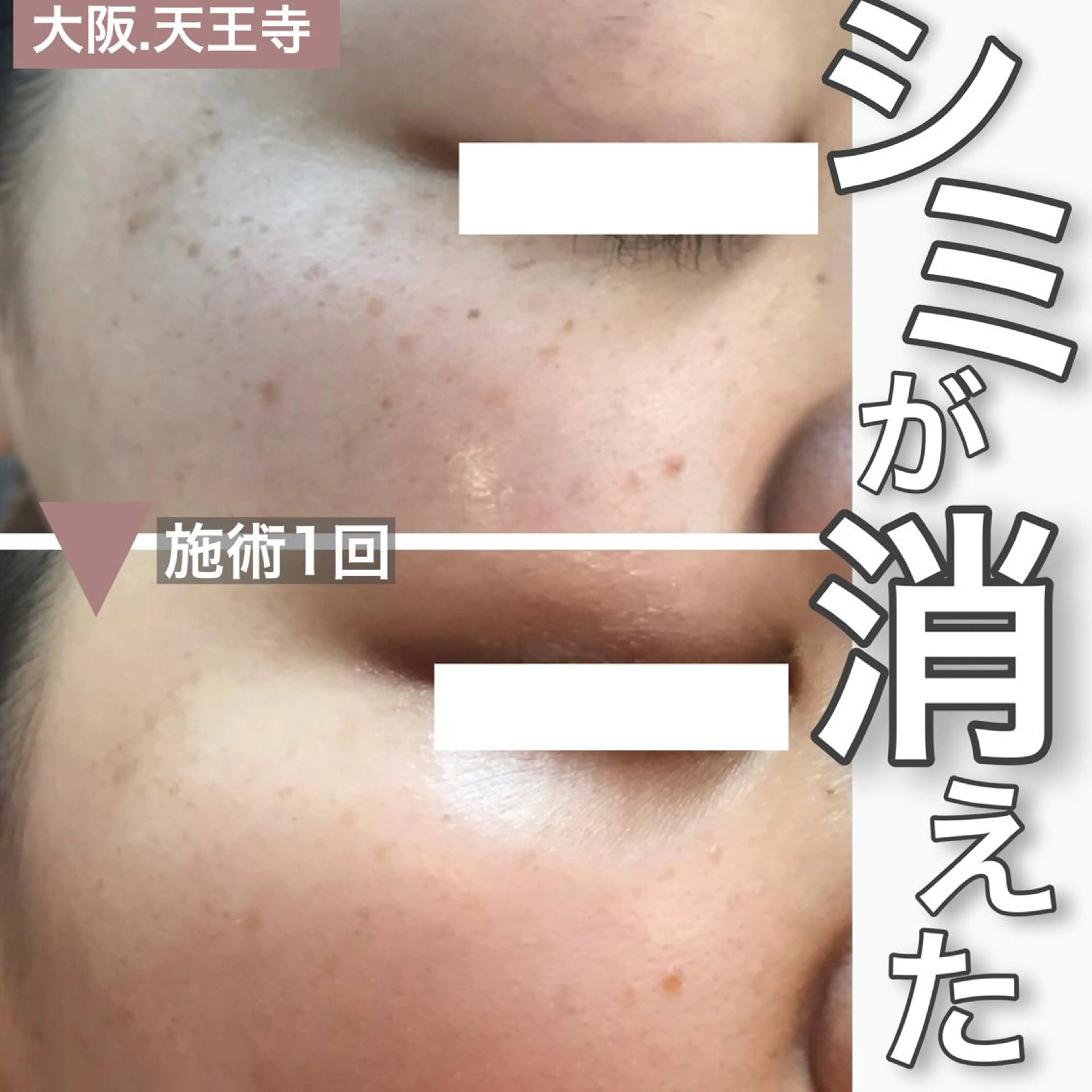 マツエク・マツパ 【しみ毛穴専門店】beautysalon Ankh所属・しみ毛穴専門店 Ankh 平田のエステ・リラクイメージ