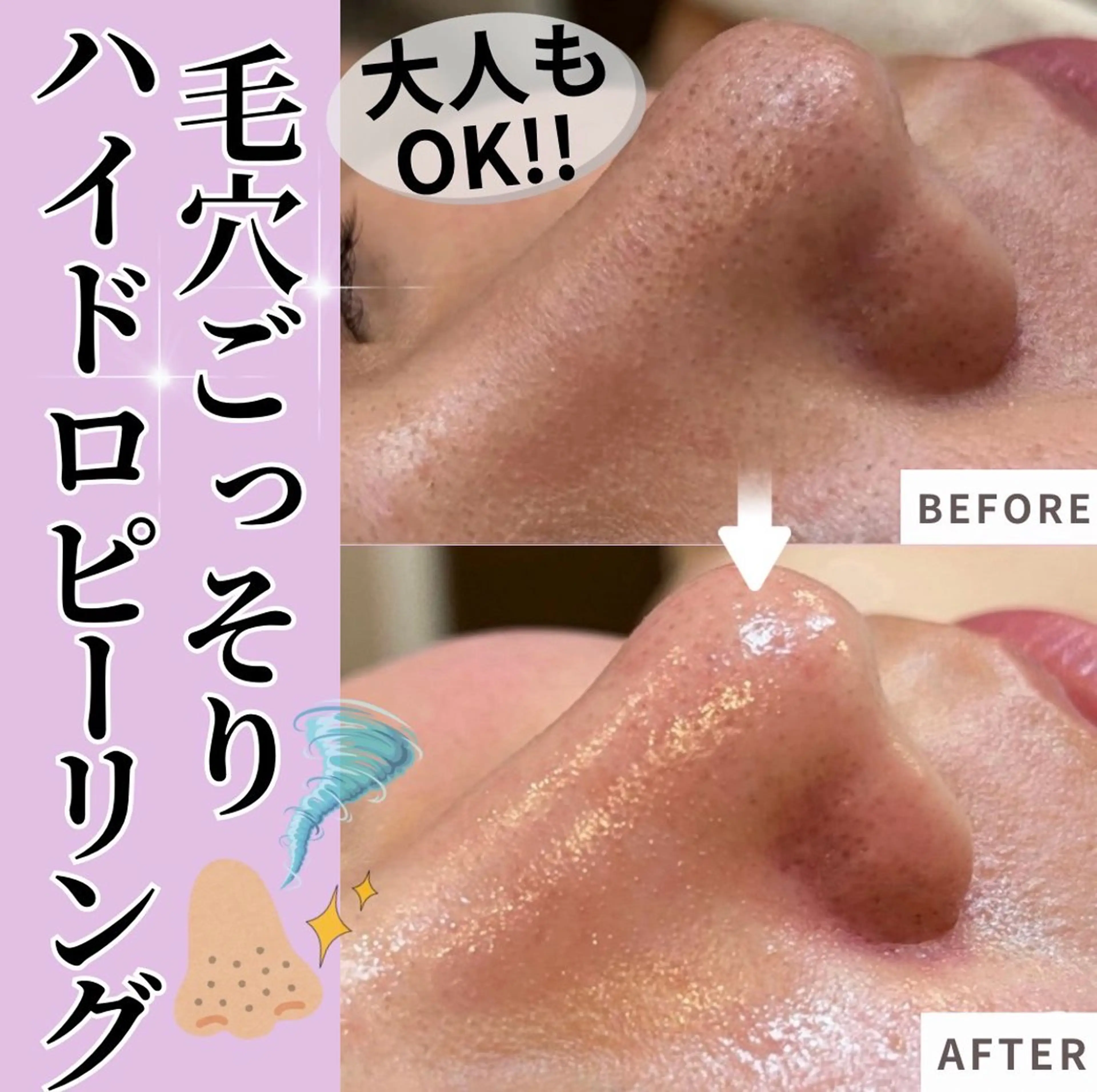 【毛穴/ザラつき/いちご鼻に◎】大人もok♪ハイドロ毛穴ツルスベ洗浄(約40分)の写真