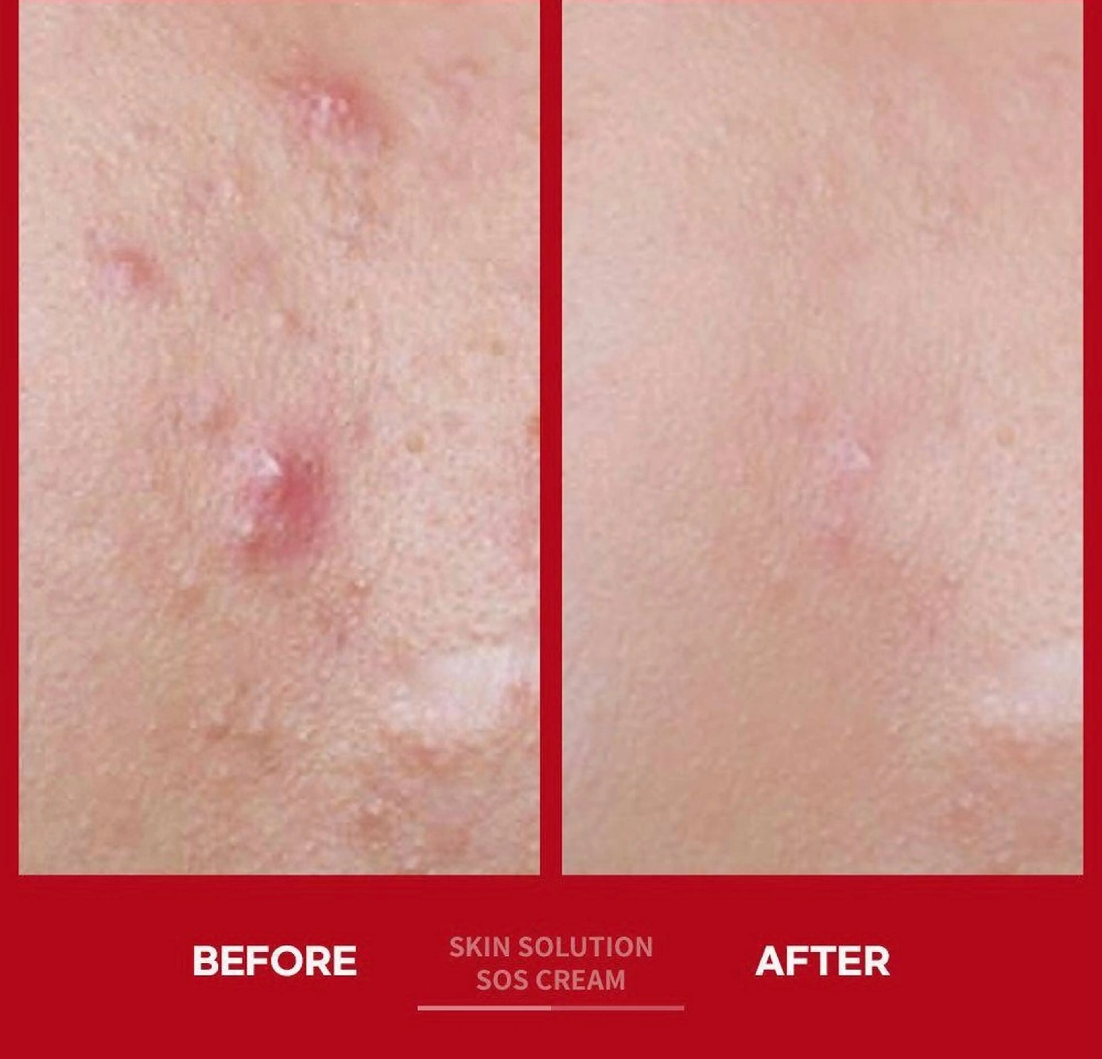 ニキビ肌ケアコース。赤ニキビ・大人ニキビ等の肌荒れ、ニキビ悩みのメニュー。の写真