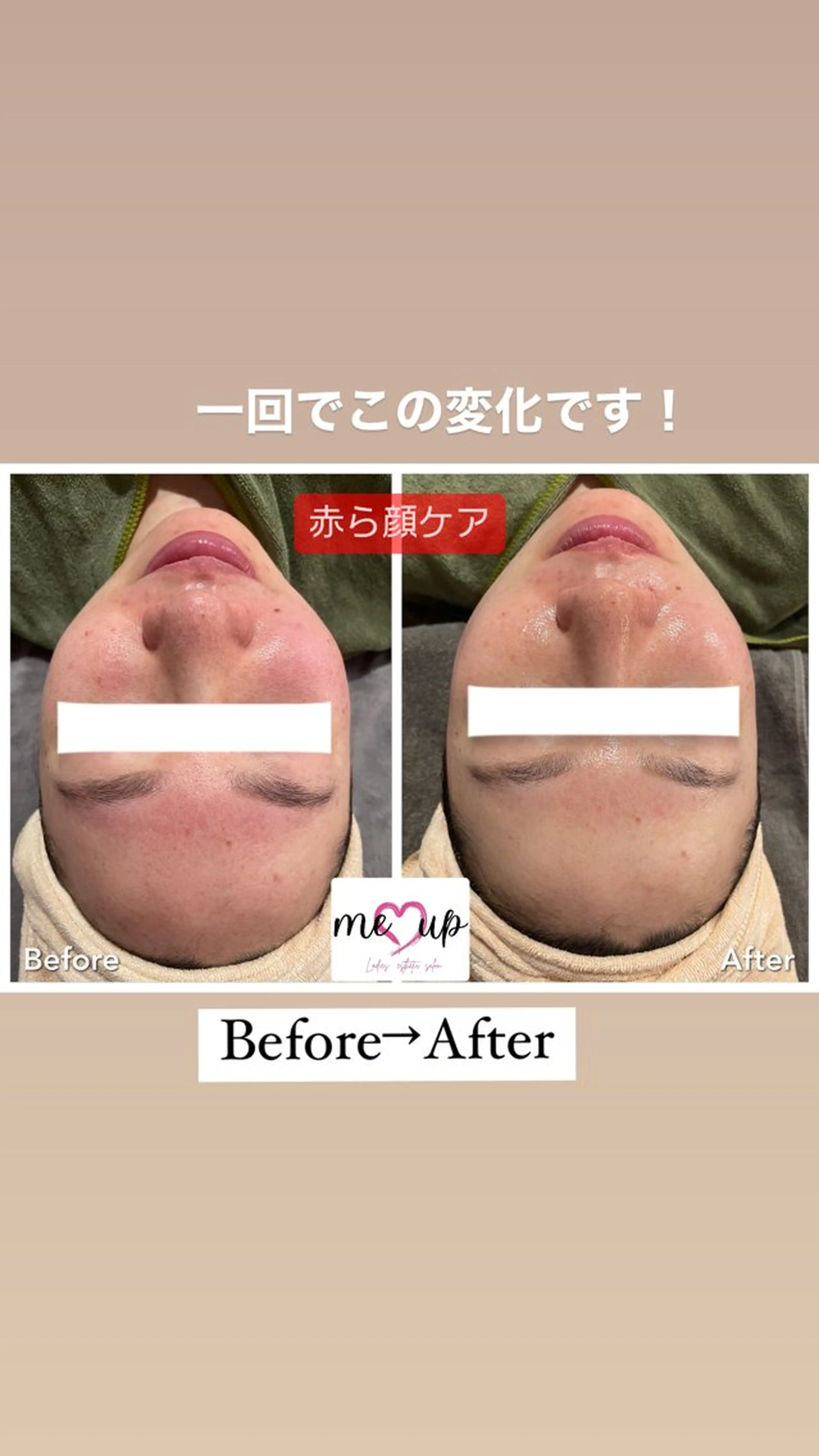 エステ Meupニキビ専門店 背中/ハーブ/肌管理のその他イメージ