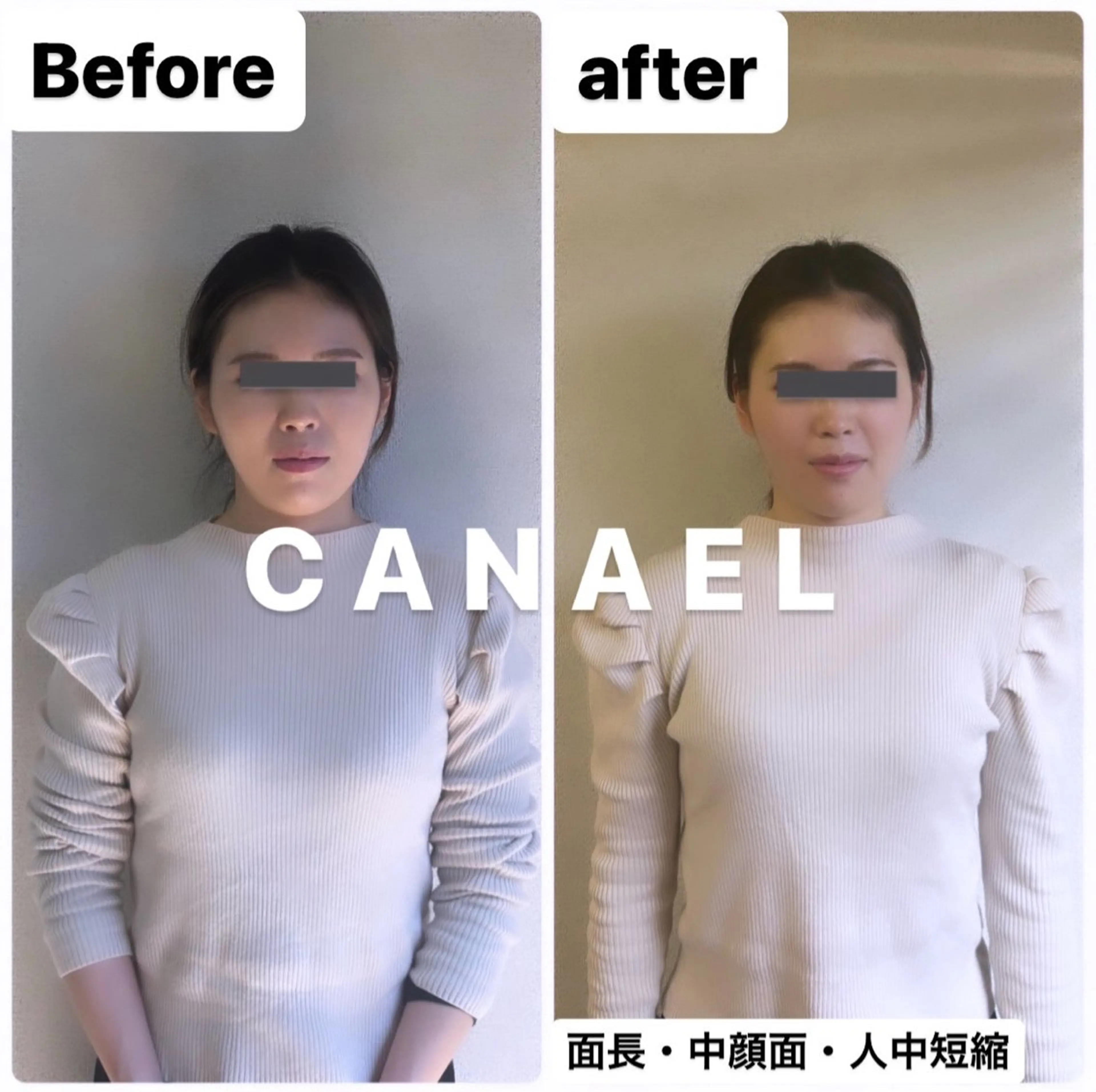 【頭蓋骨/小顔矯正】顔が長い/面長/中顔面短縮コースの写真