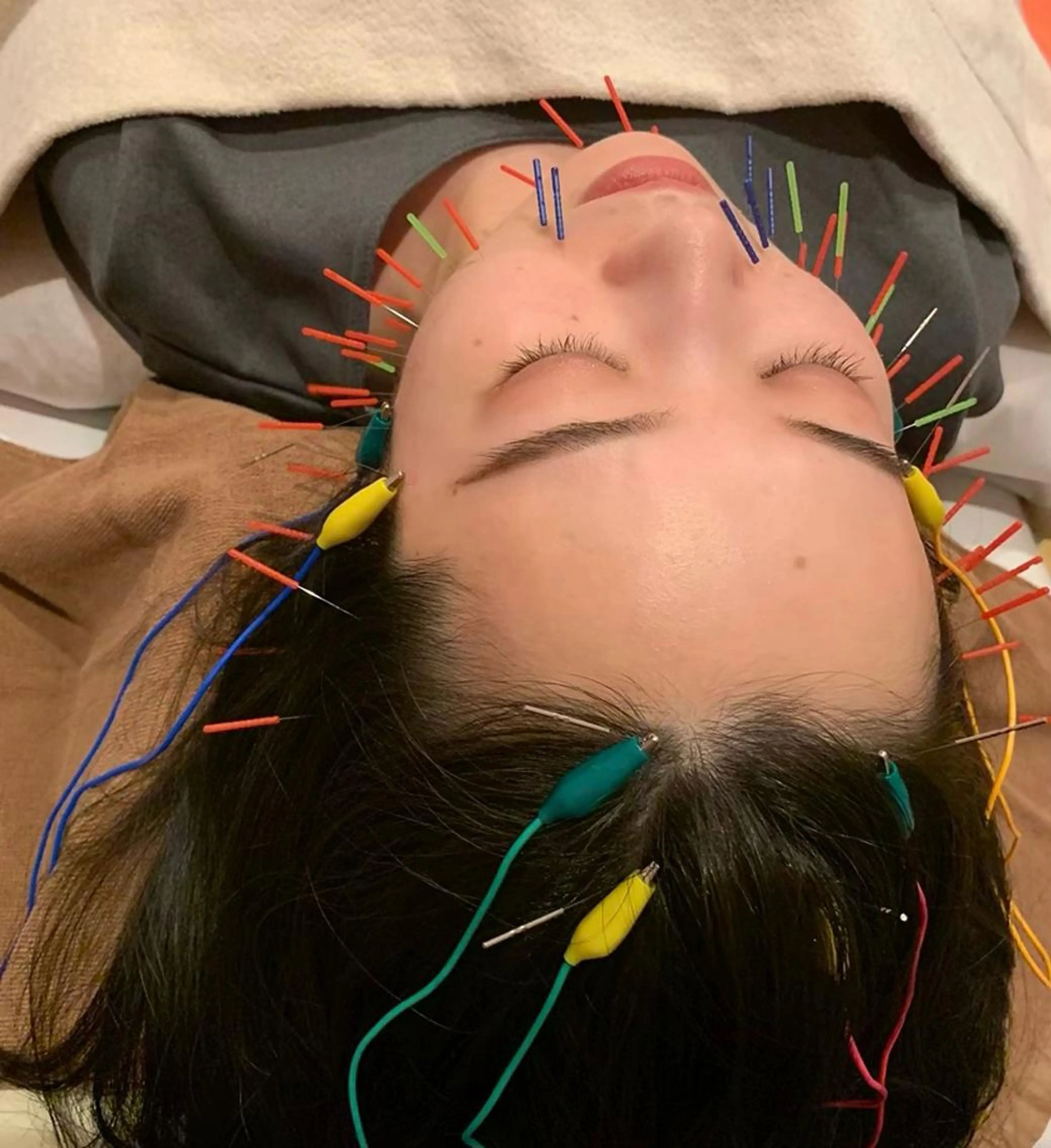 1人気no1メニュー✨美容鍼🪡×オイル小顔調整マッサージ💆‍♀️（首肩デコルテマッサージ付き）の写真