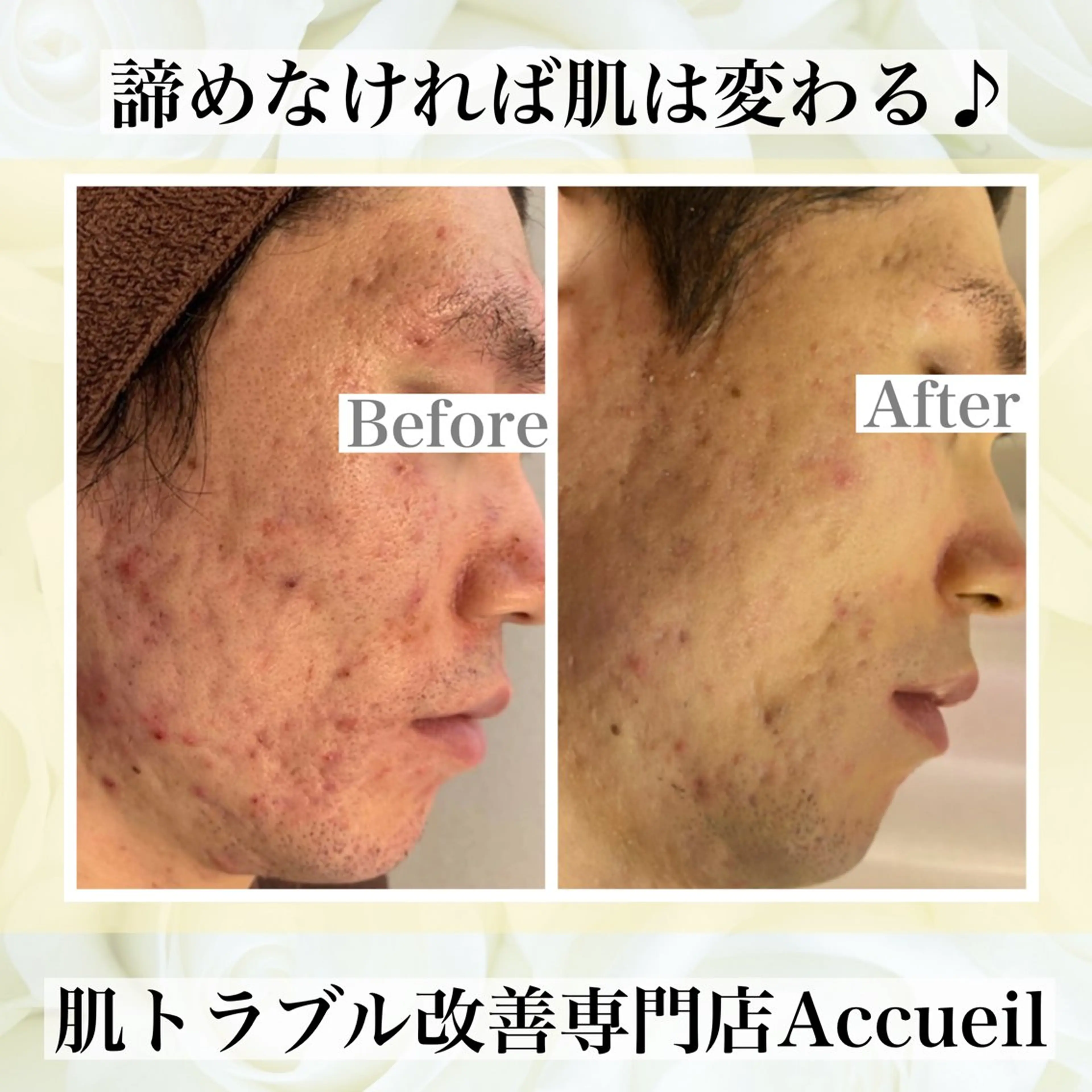 エステ リラク ニキビ・肌質改善専門 ♡人生が変わるサロンのエステ・リラクイメージ