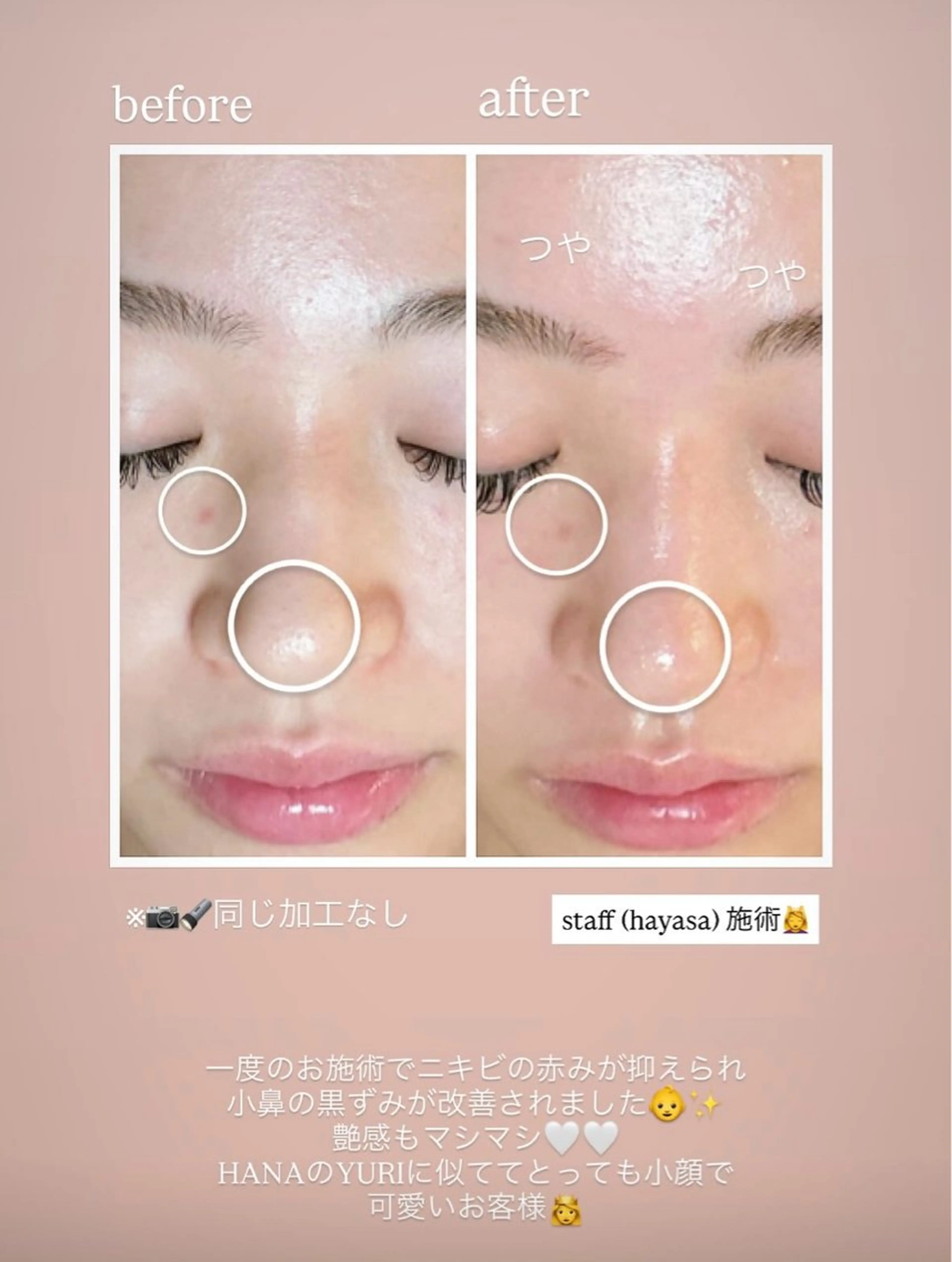 《歴5年staff施術》韓国艶肌フェイシャル ¥8,800 → ¥4,500 毛穴洗浄＋ヒト幹細胞の写真