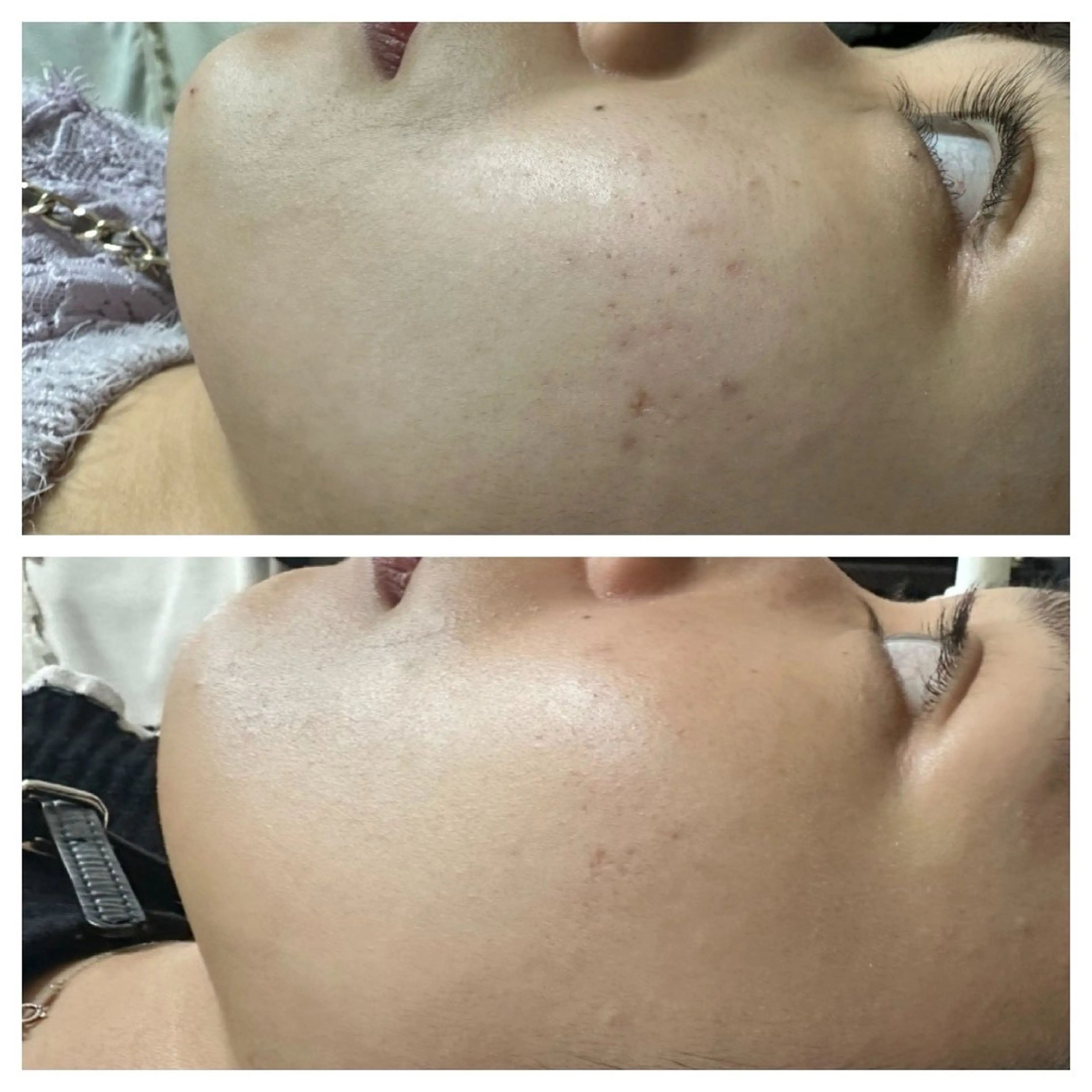 小顔・毛穴/ニキビ/ ハーブピーリング専門のエステ・リラクイメージ