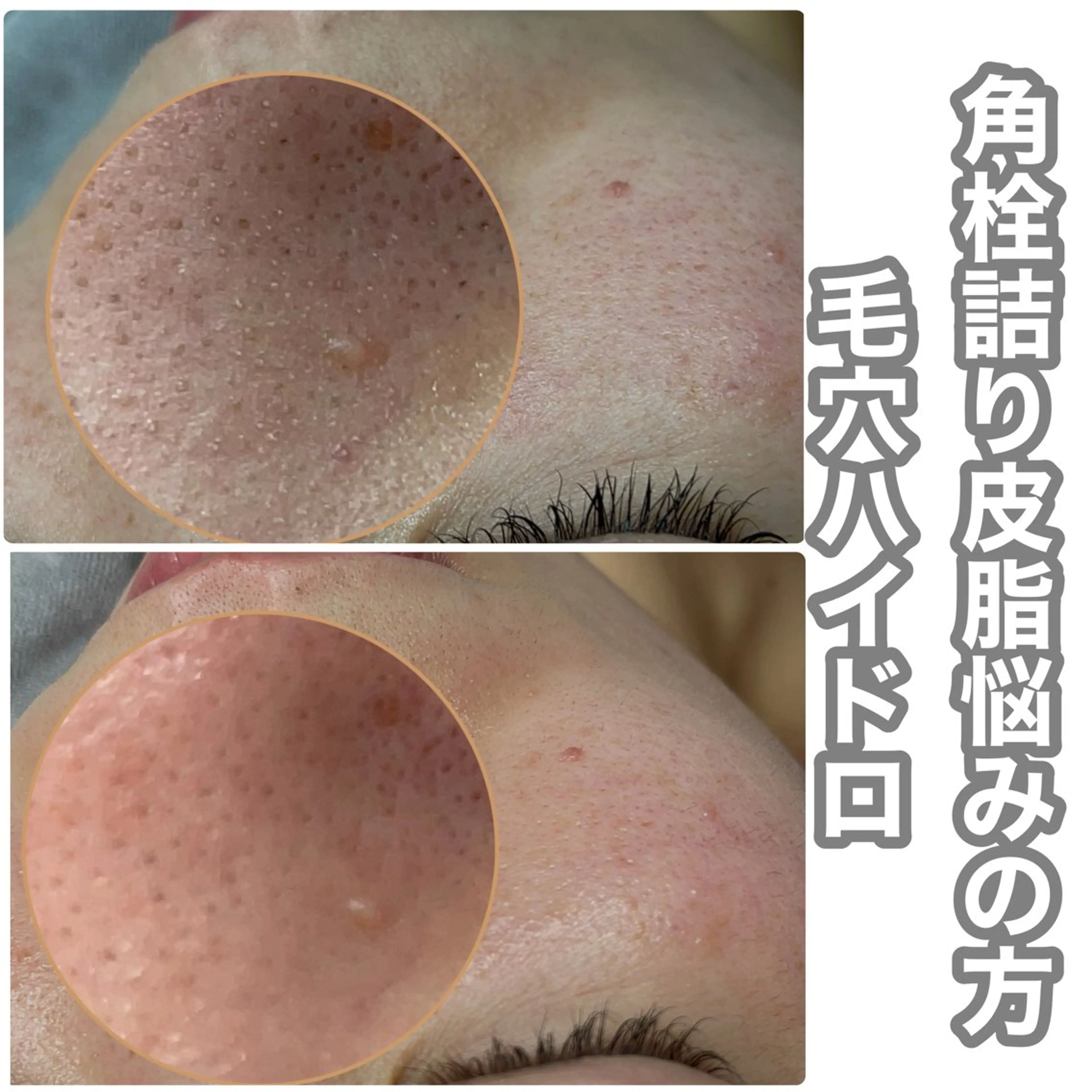 エステ Chalon所属・REVI取扱・肌悩み 毛穴Chalonのエステ・リラクイメージ