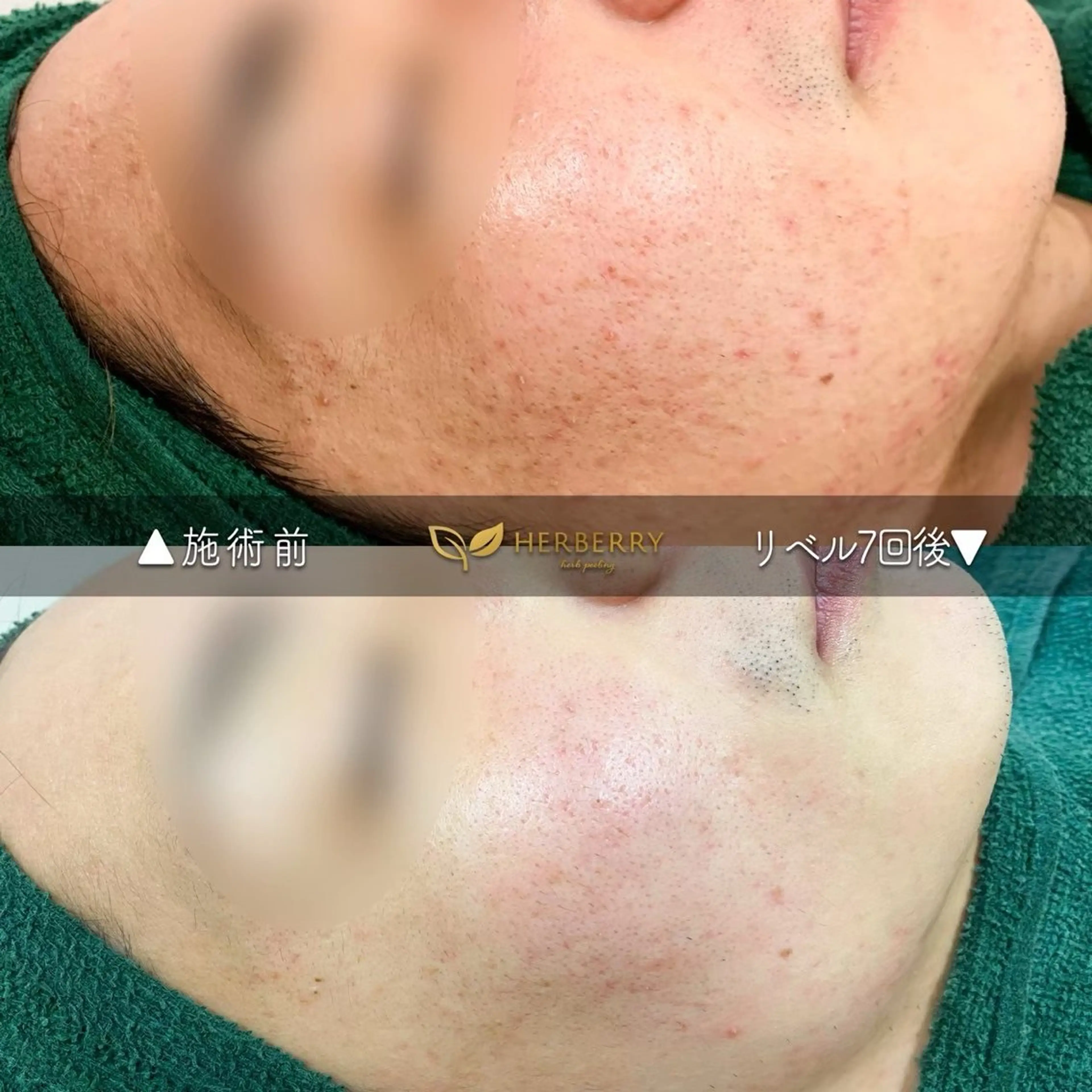 BLANC.【新宿店】所属・ハーブピーリング ayamiのエステ・リラクイメージ