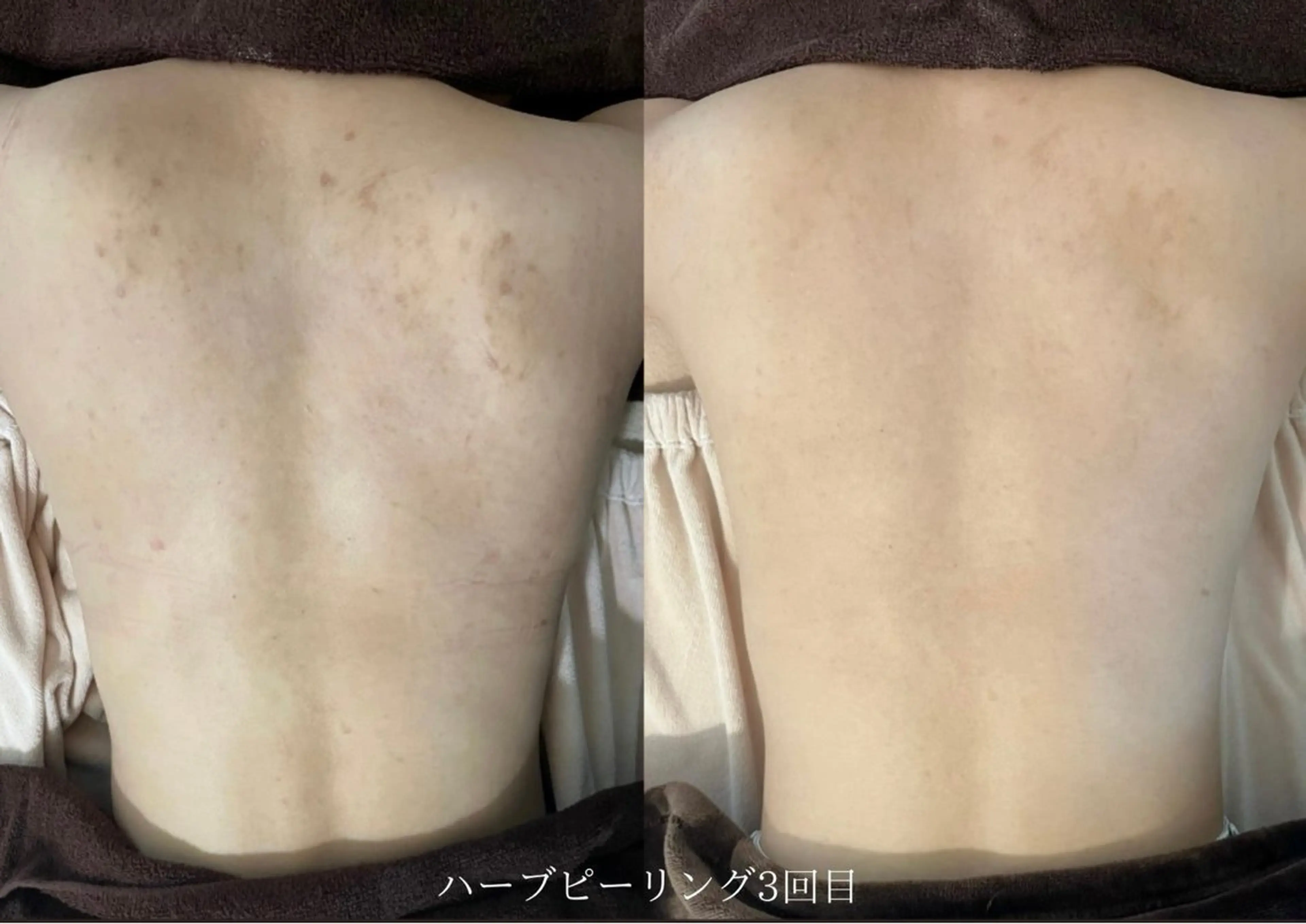 【背中剥けるハーブピーリング】ダウンタイムありますの写真