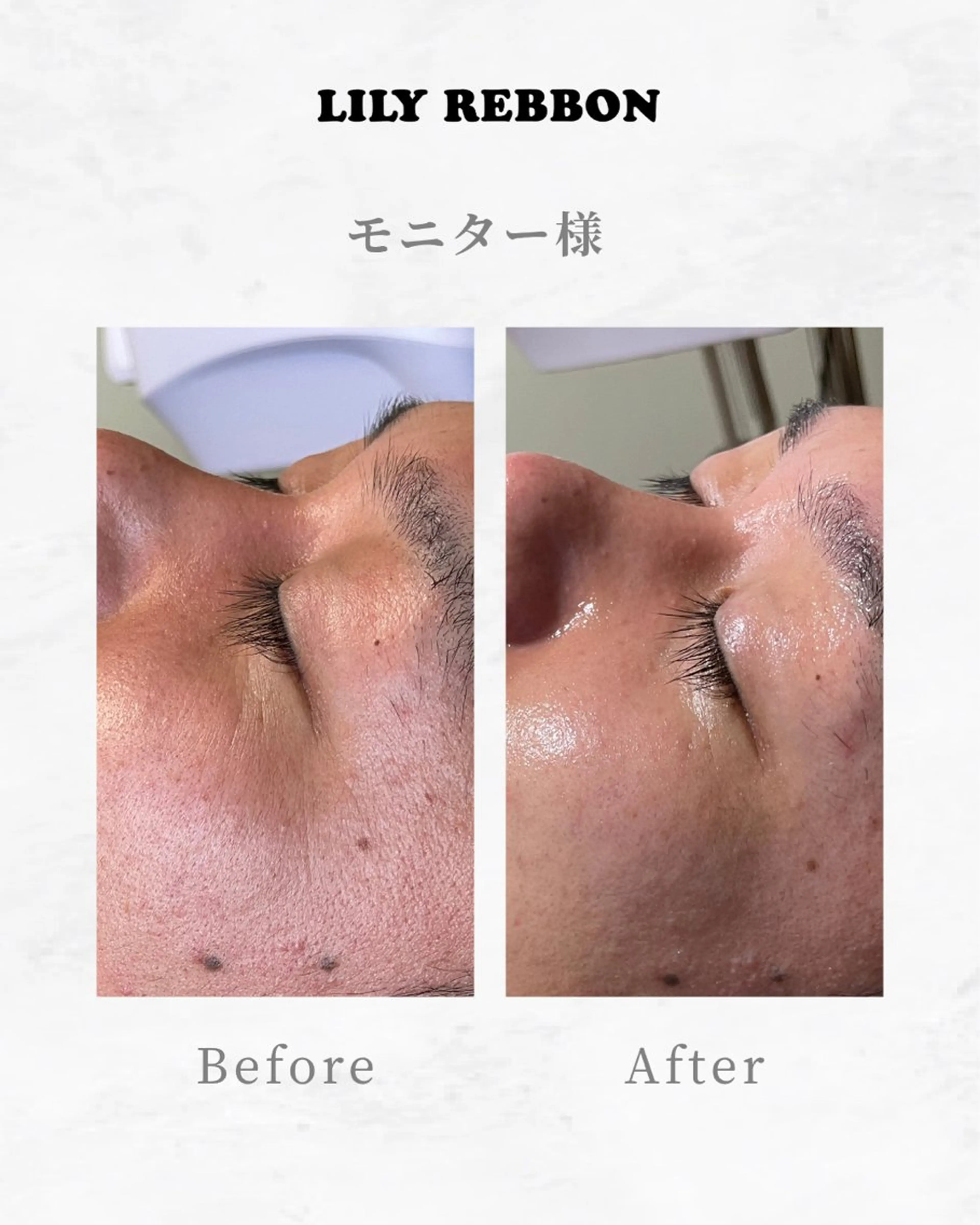 生コラーゲン導入+パック+サルサーの写真