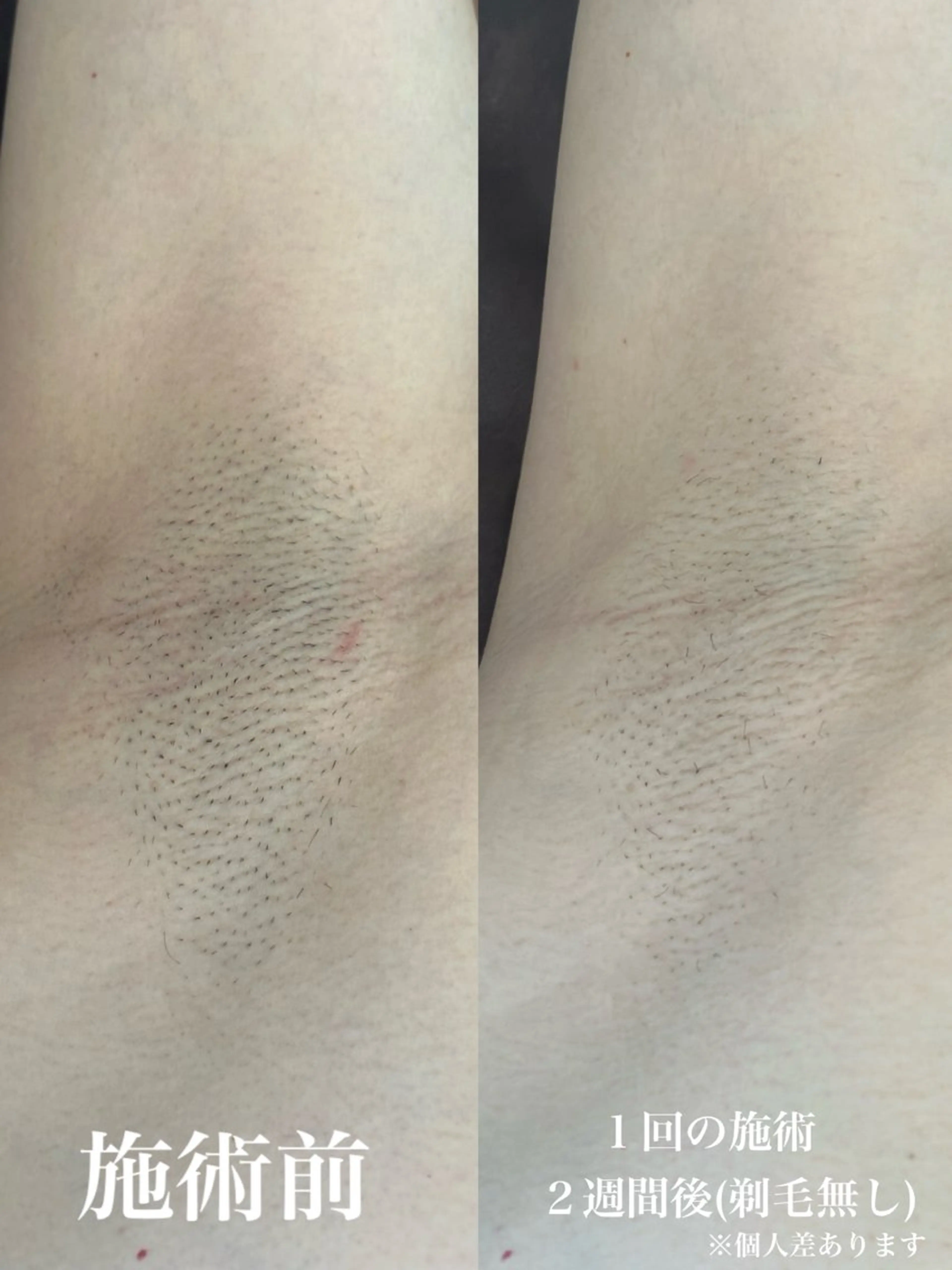 メンズ 脱毛 muumo所属・muumo まりののエステ・リラクイメージ