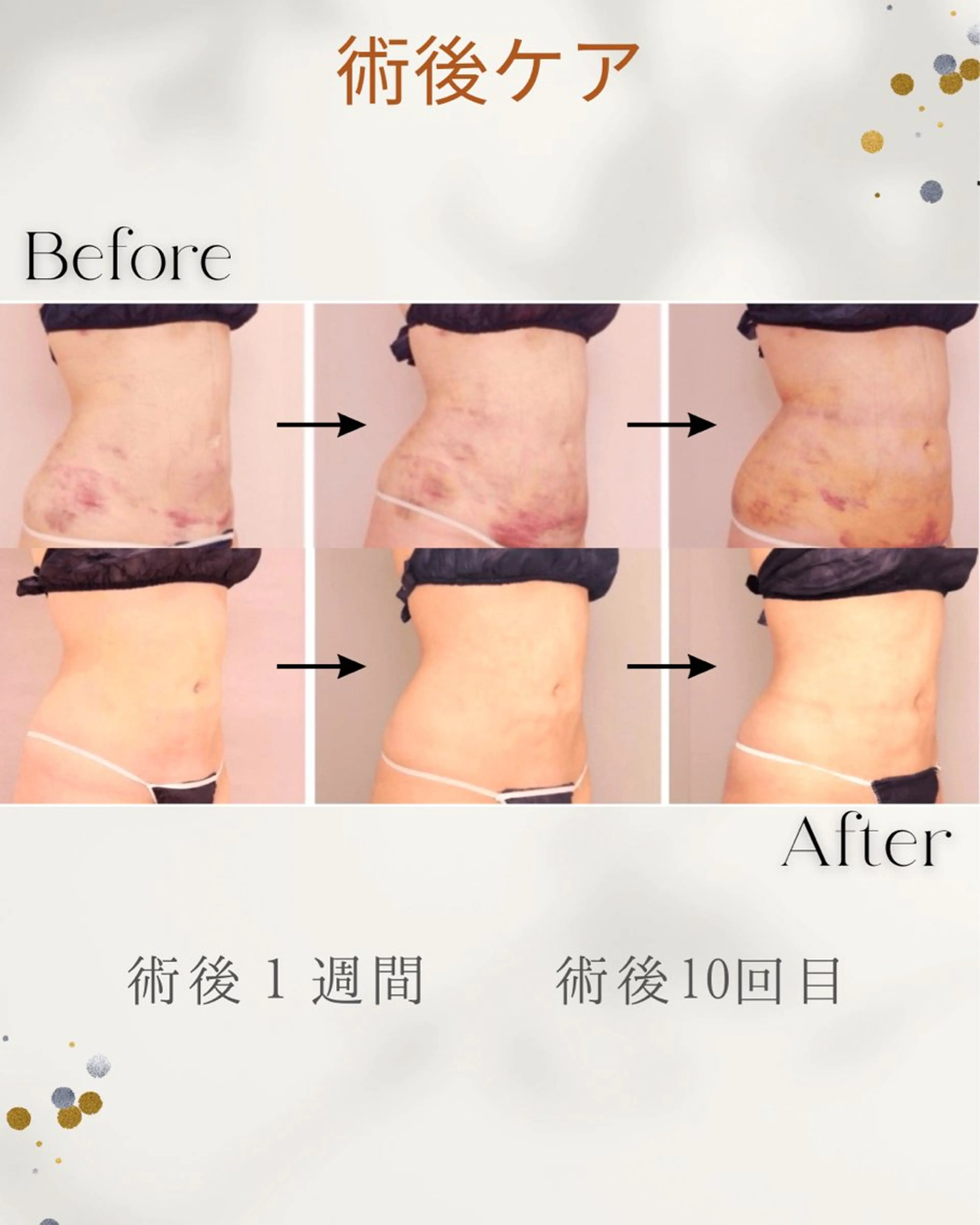 ⚠️予約確認必須【再来・術後ケア60分】顏/ボディ、拘縮、内出血、ダウンタイム短縮!都度15,000円の写真