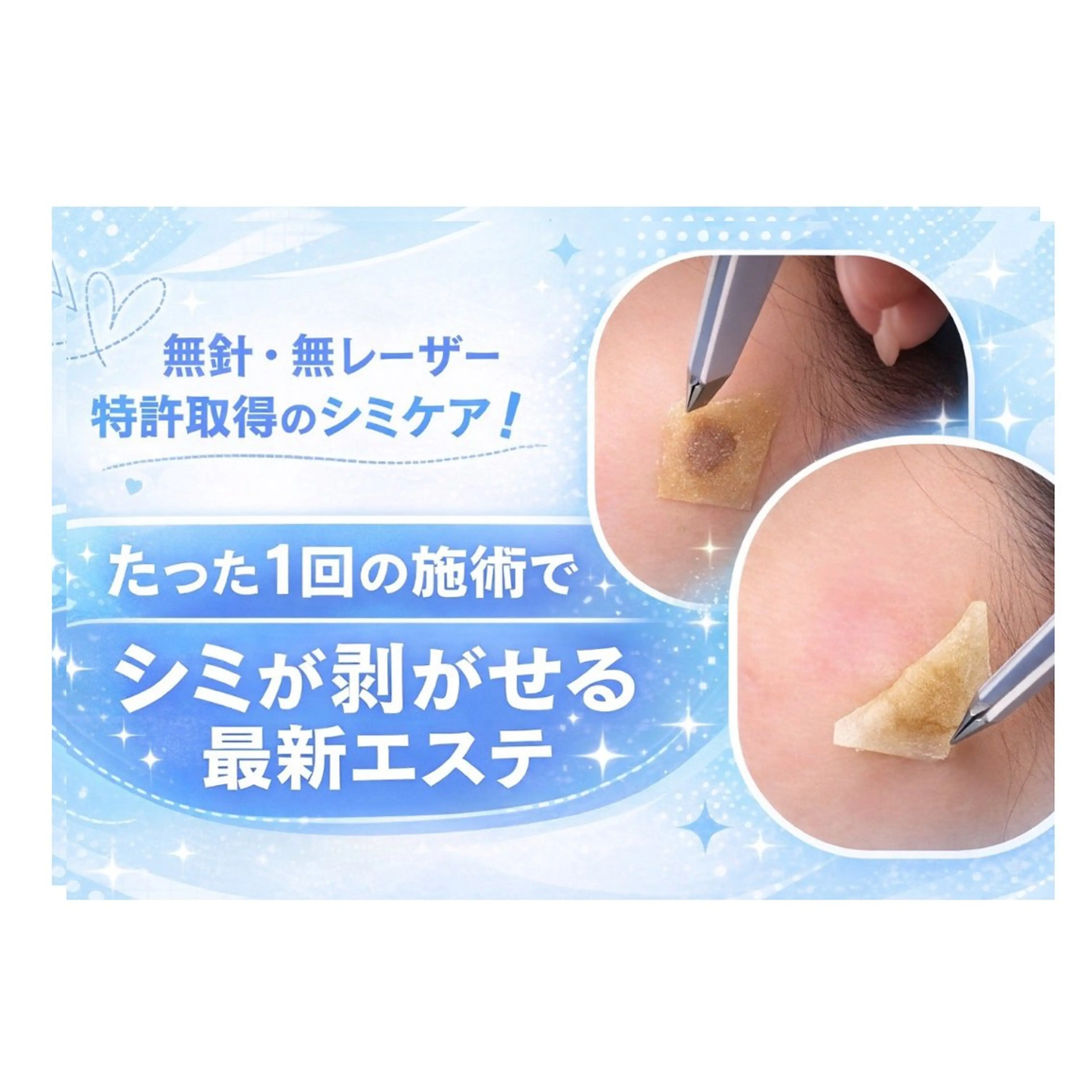 8日でシミ卒業の写真