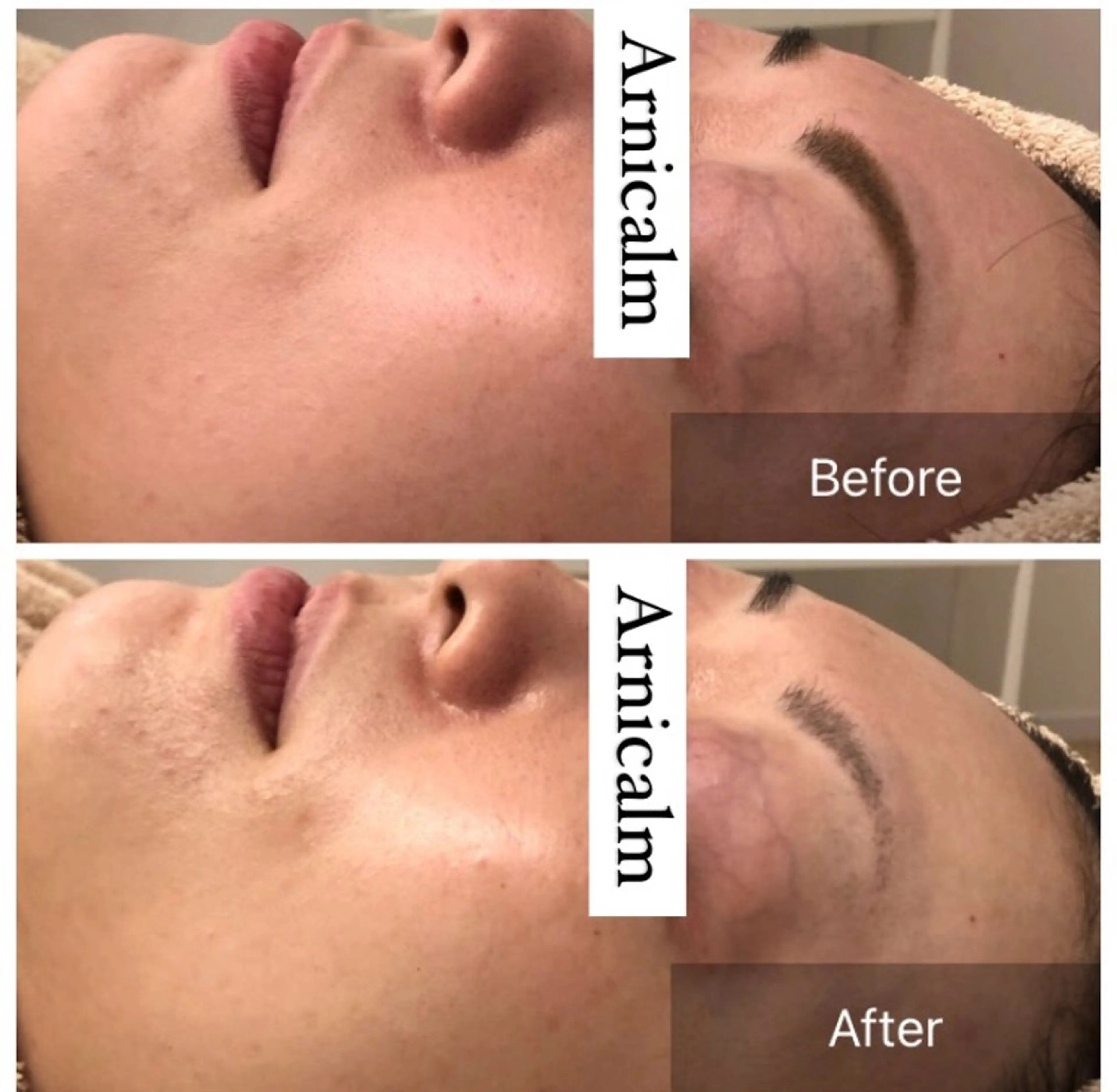 エステ ハーブピーリング 肌再生ピーリング/のエステ・リラクイメージ