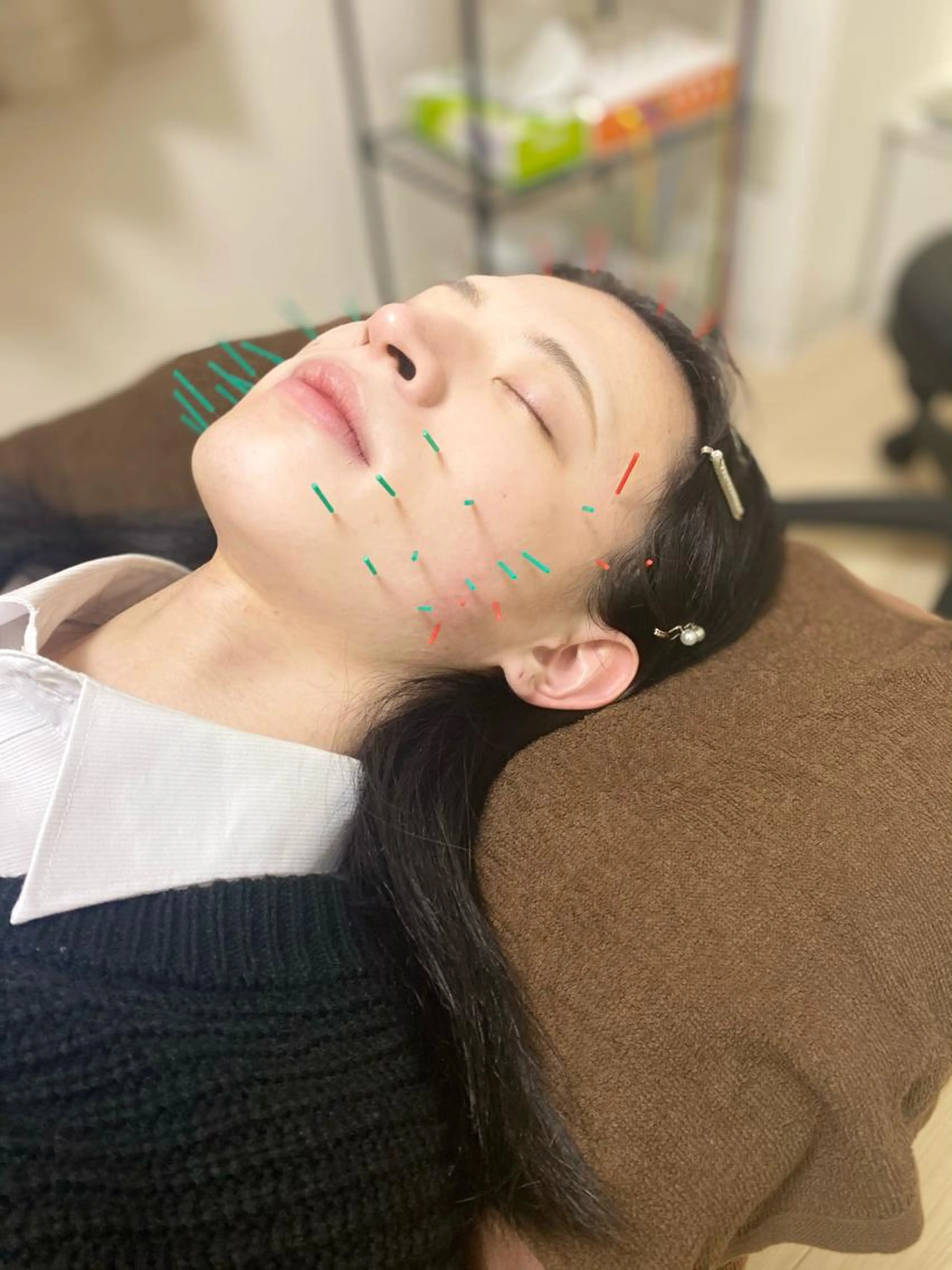 美容鍼でリフトアップ&シワ改善しませんか？初回¥3000！！の写真