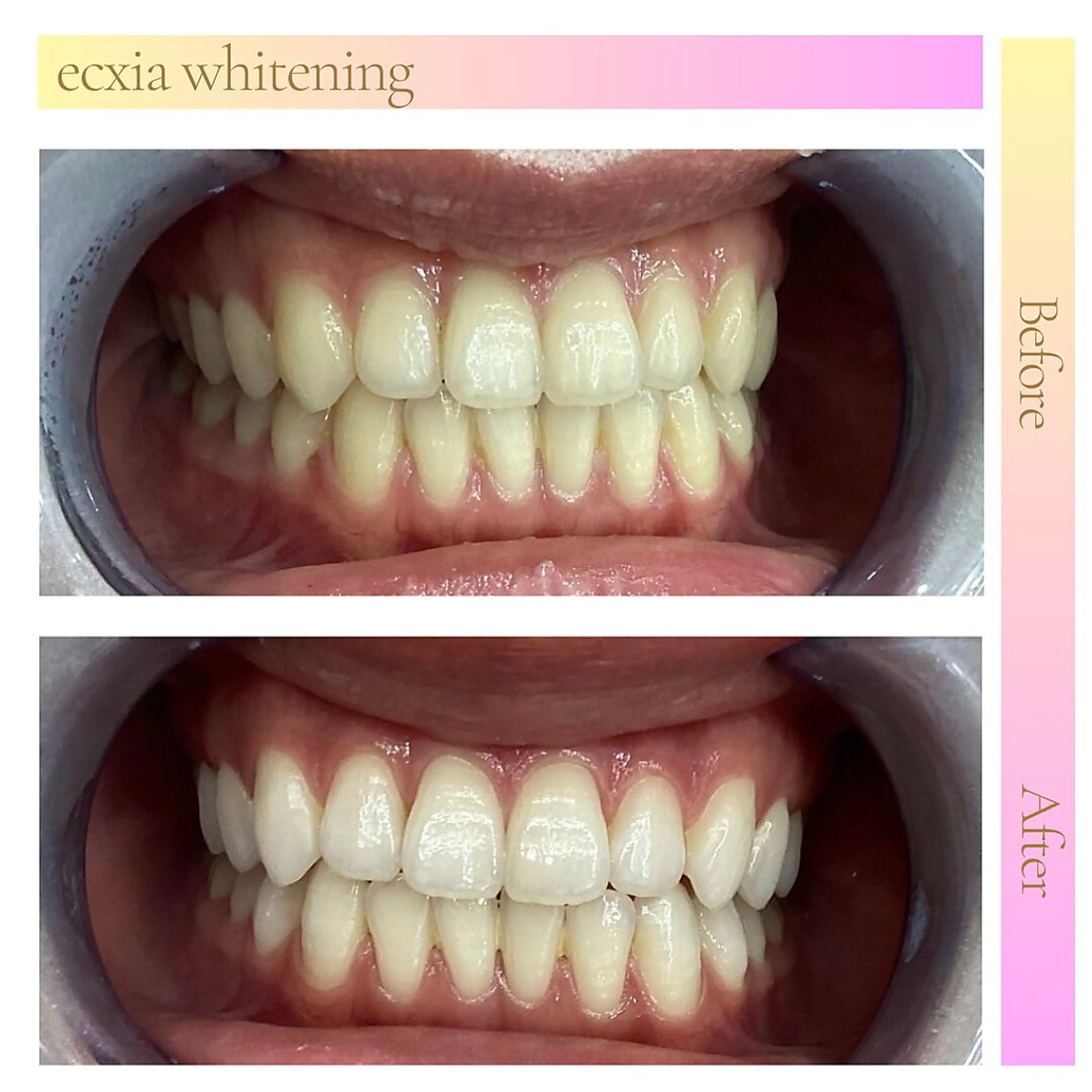 【minimo掲載記念】セルフホワイトニング（9分×2回）¥980 別途料金なしの写真