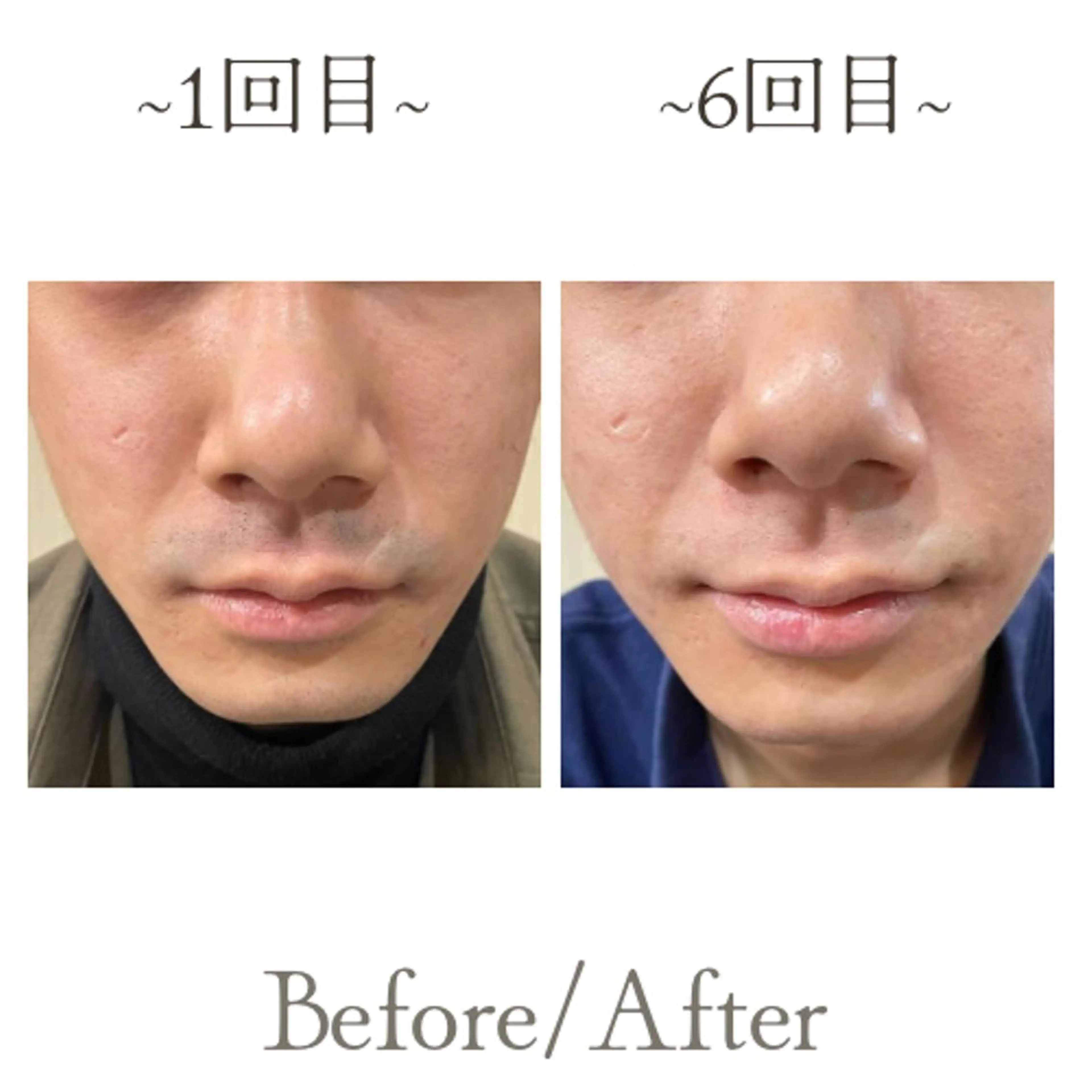 脱毛 メンズサロンGRACE所属・salon GRACEのエステ・リラクイメージ