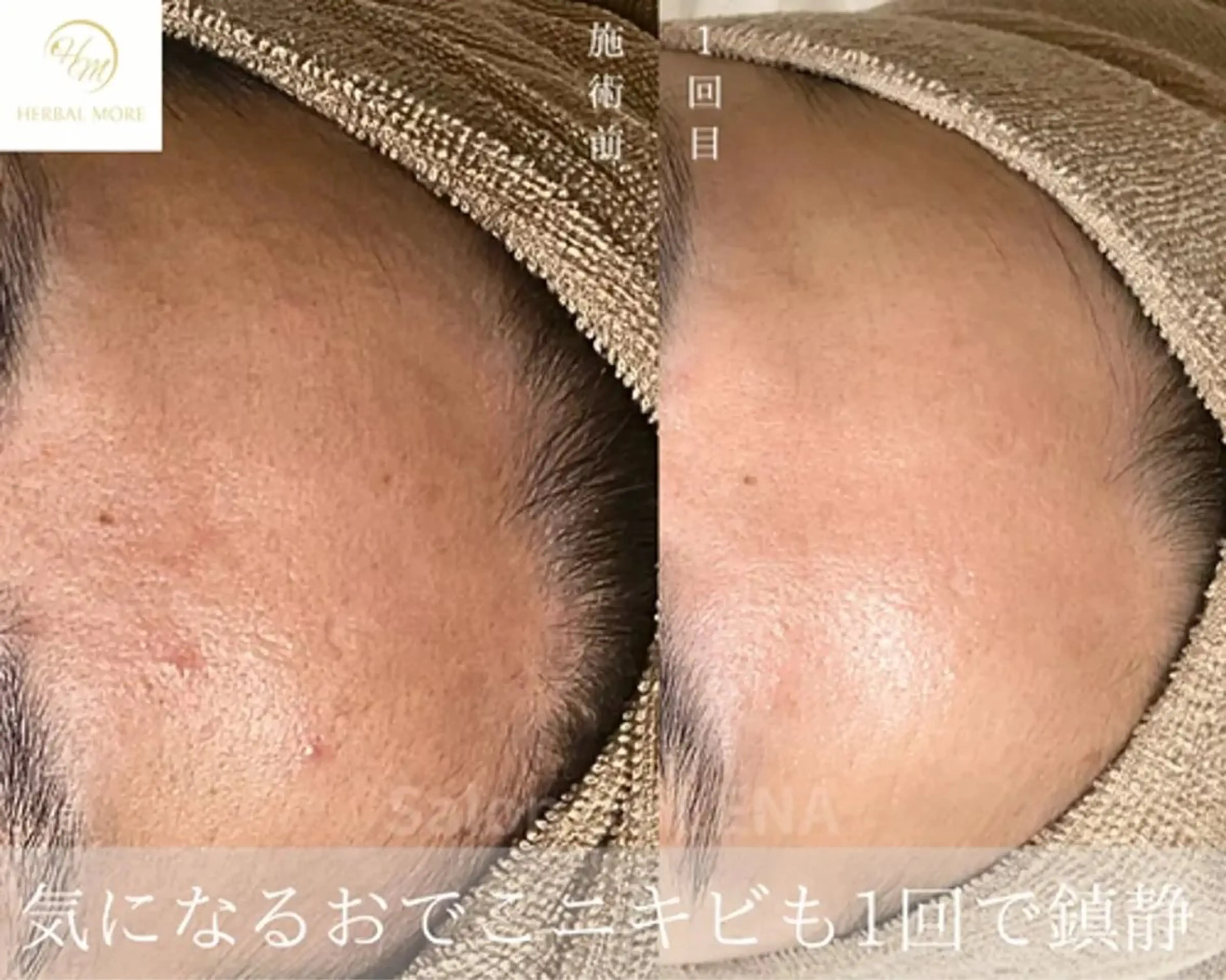 Grandir所属・ハーブピーリング専門 グランディール　武内のエステ・リラクイメージ