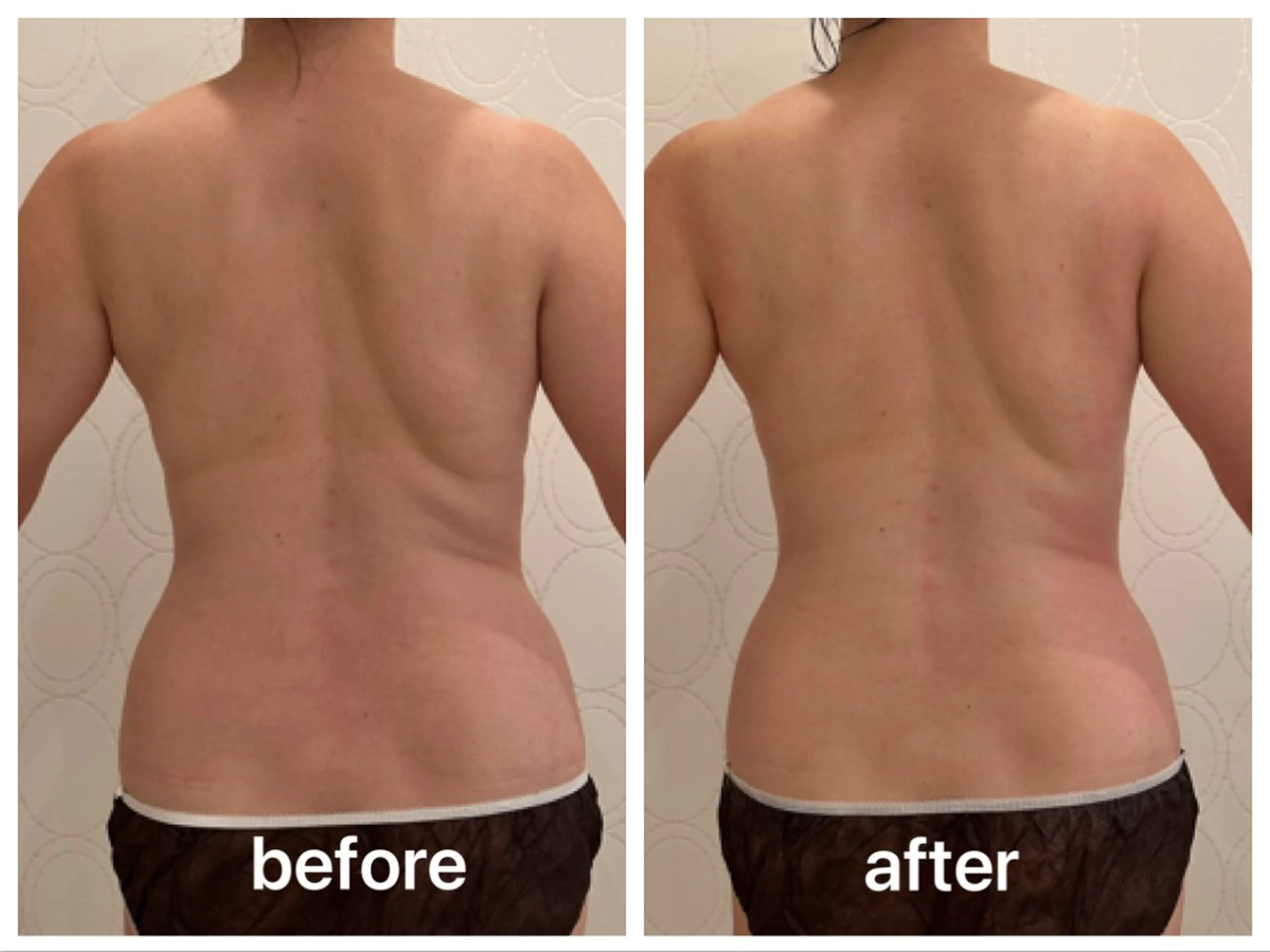 ⭐️ミニモ限定⭐️キャビテーション✖️クラッシュ吸引！上半身痩身（背中・お腹・腰回り）痩身マシーンで温め＆セル撃退40分の写真