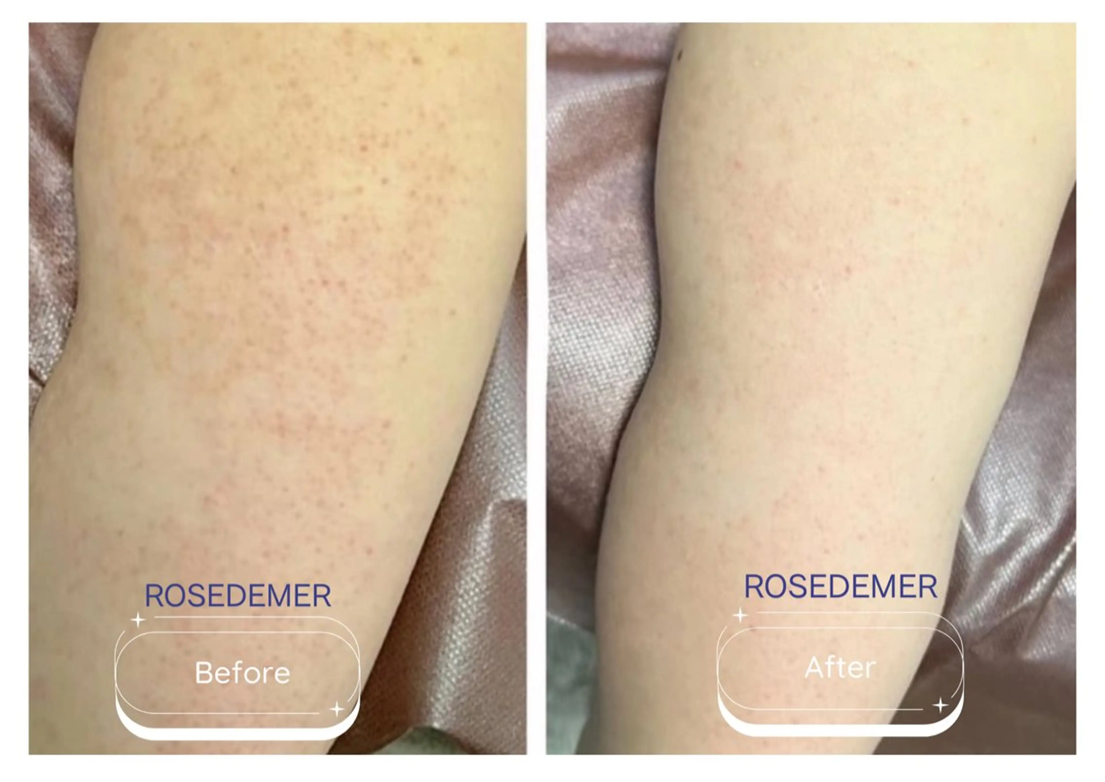 モニター募集✨剥離あり◎【二の腕ハーブピーリング🌿】ザラつき/ニキビ/ニキビ跡/色素沈着/毛孔性苔癬/毛孔性角化症の写真