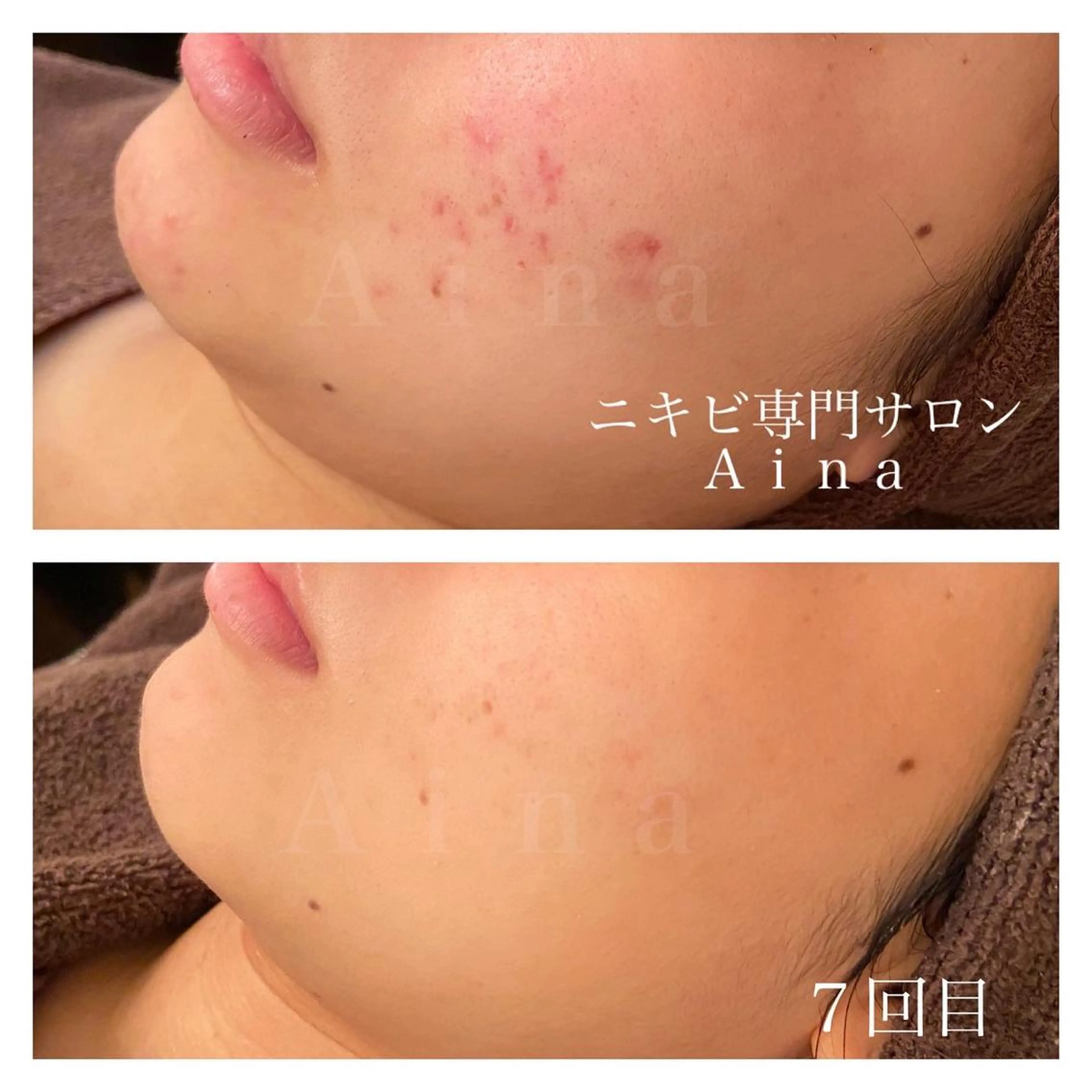 セミロング パーマ ヘアアレンジ メンズ キッズ ネイル マツエク・マツパ ニキビ跡専門サロン Ainaのエステ・リラクイメージ