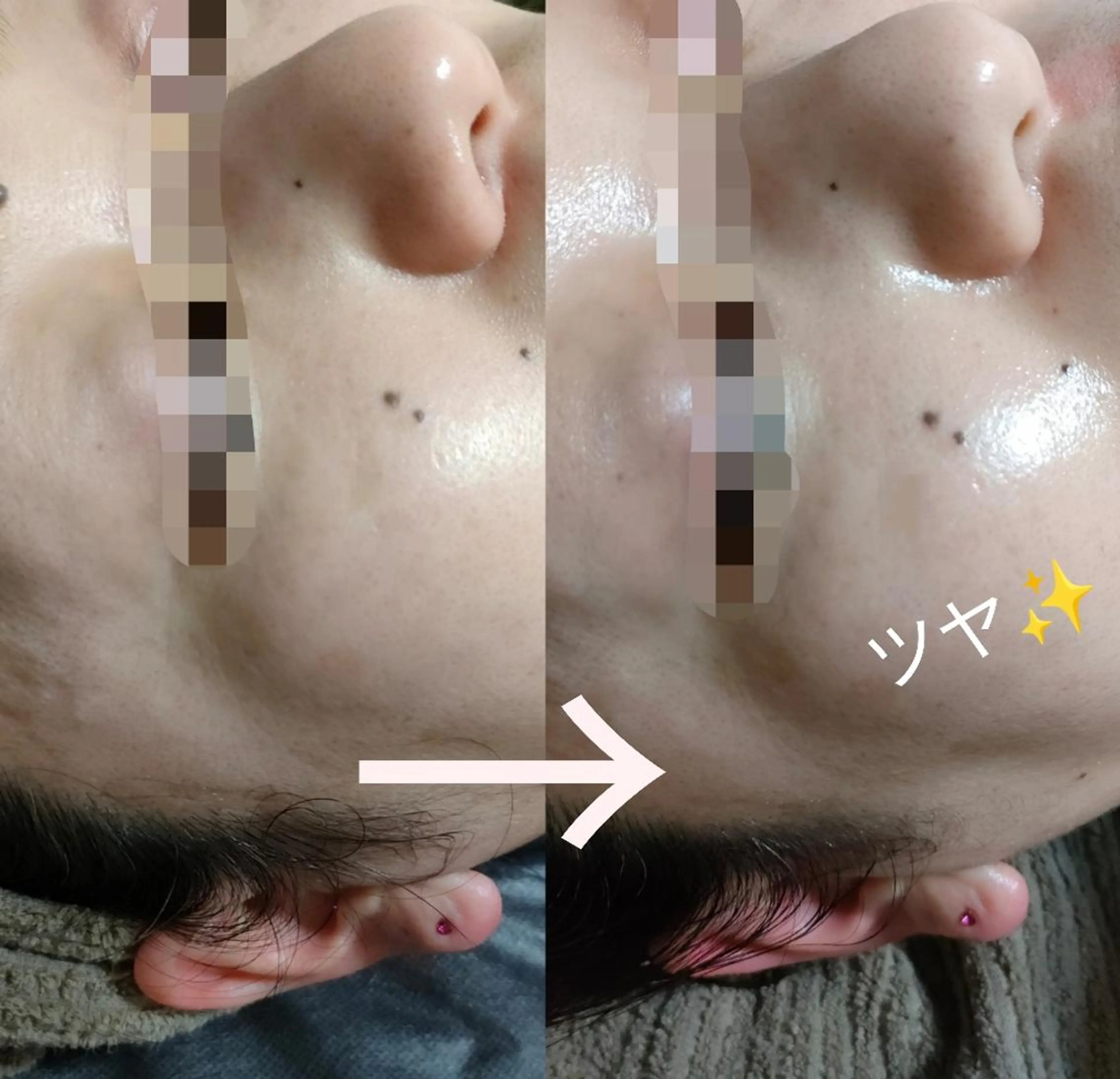 【新規】美肌を作るマツヤニWAX+泥バック　毛穴ケア、産毛脱毛の写真