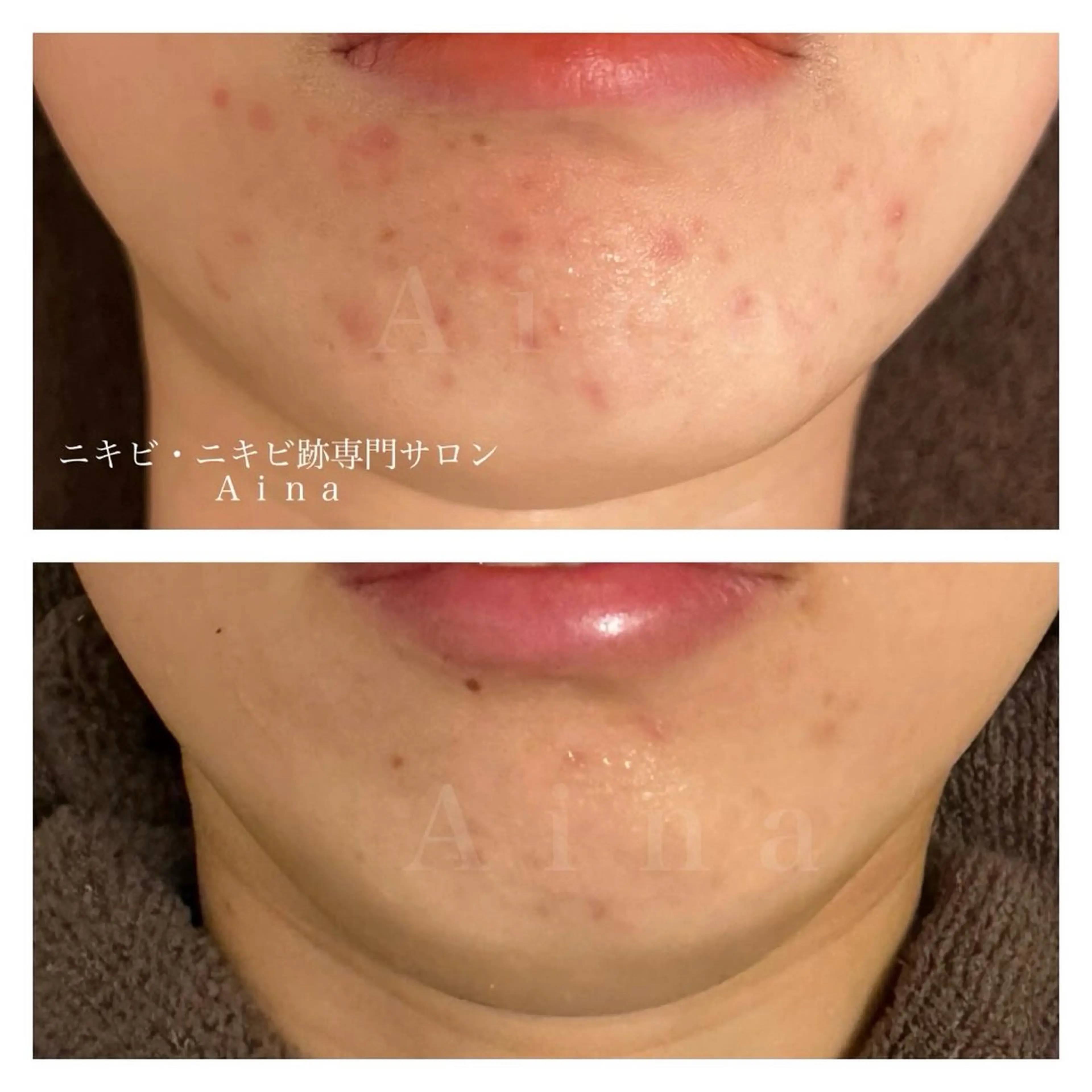 エステ リラク ニキビ跡専門サロン Ainaのエステ・リラクイメージ