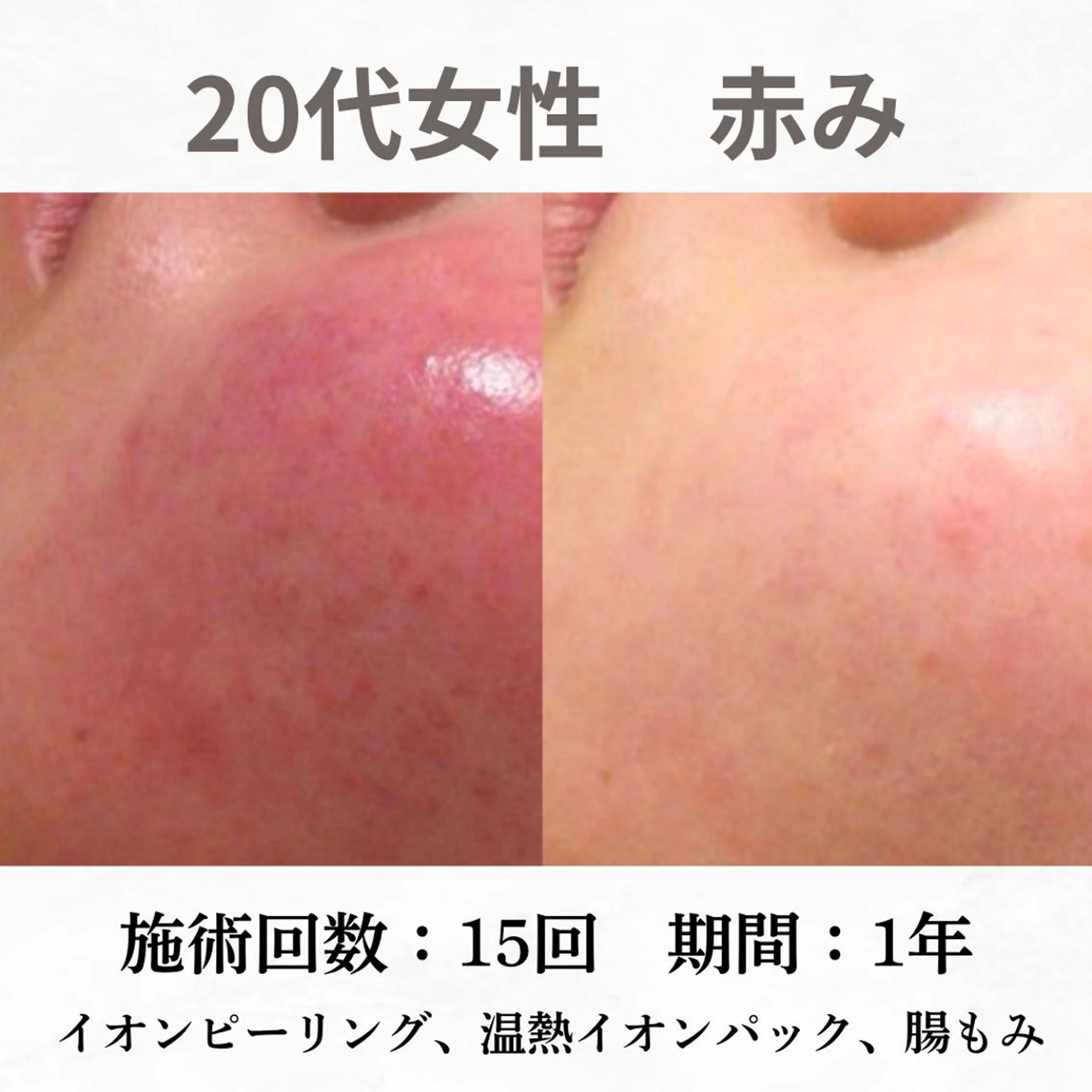 重度ニキビ専門🌷 ダウンタイムなしのエステ・リラクイメージ