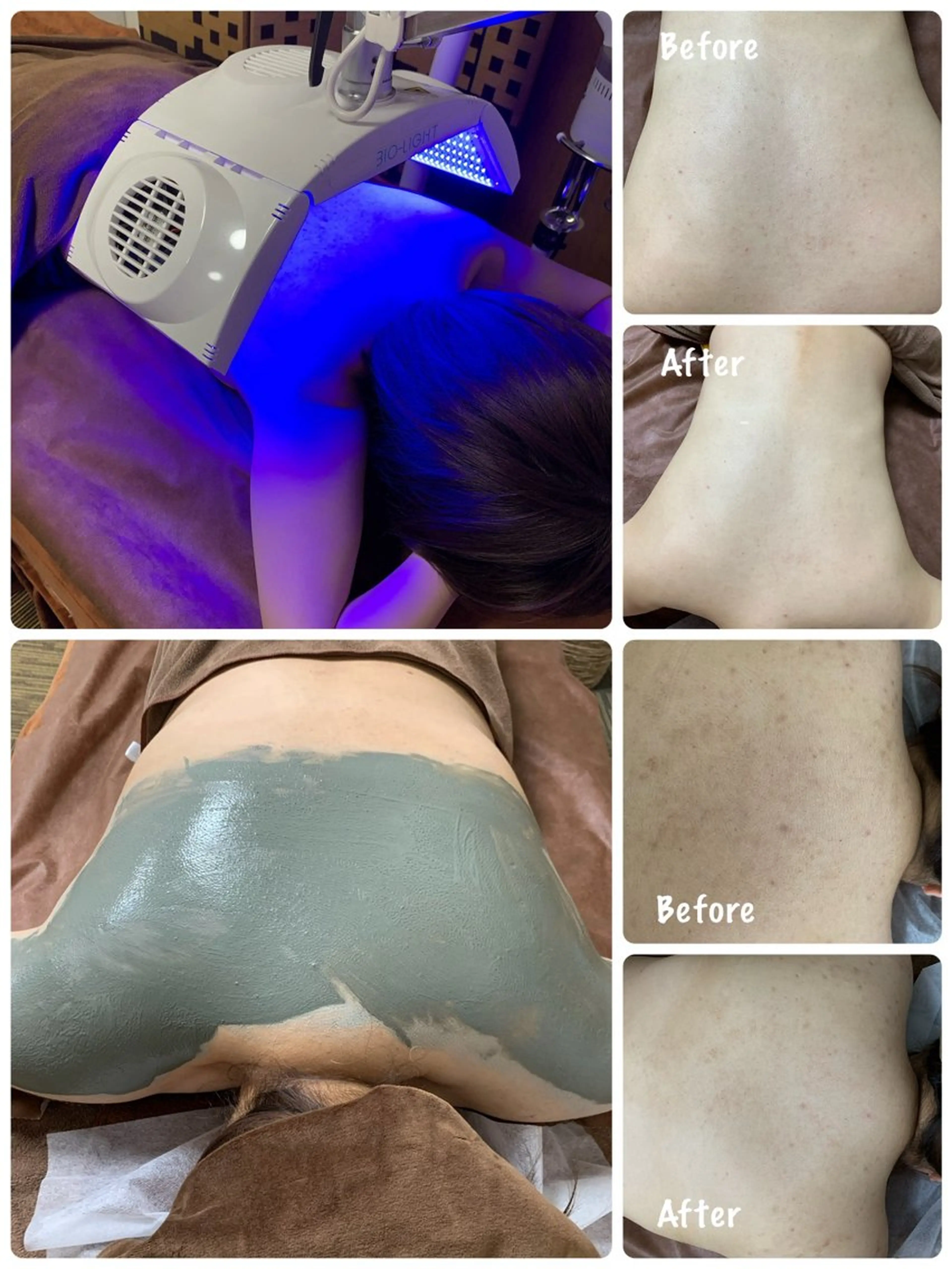 【ボディケア】3色ブレンドLED照射&ボディケアパック✨背中・二の腕・デコルテ・お尻のニキビやザラザラ感、くすみのケアにの写真