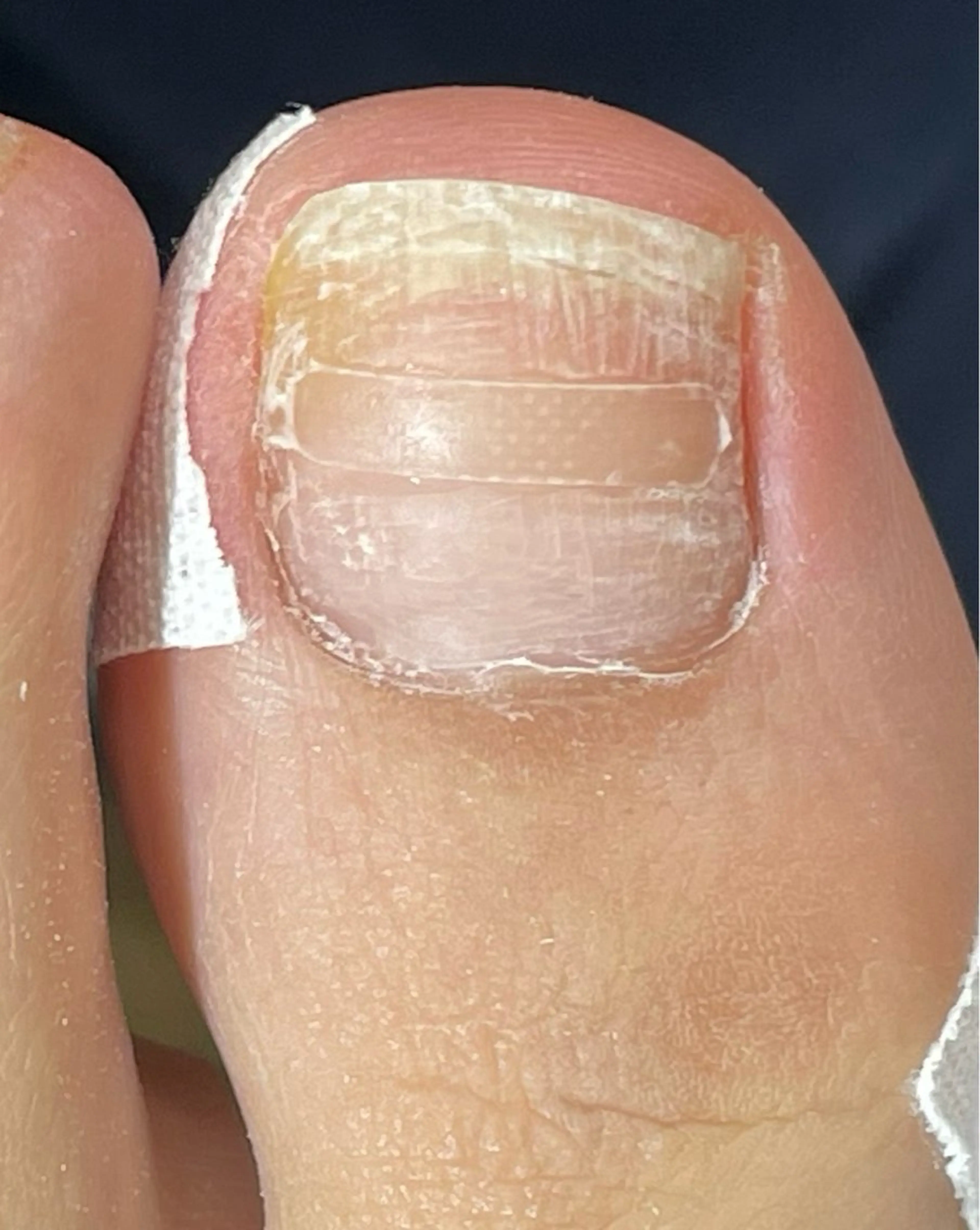 【B/Sシートによる巻き爪矯正】目立ちにくくつけた瞬間から即効性が感じられます。🫡メンズokの写真