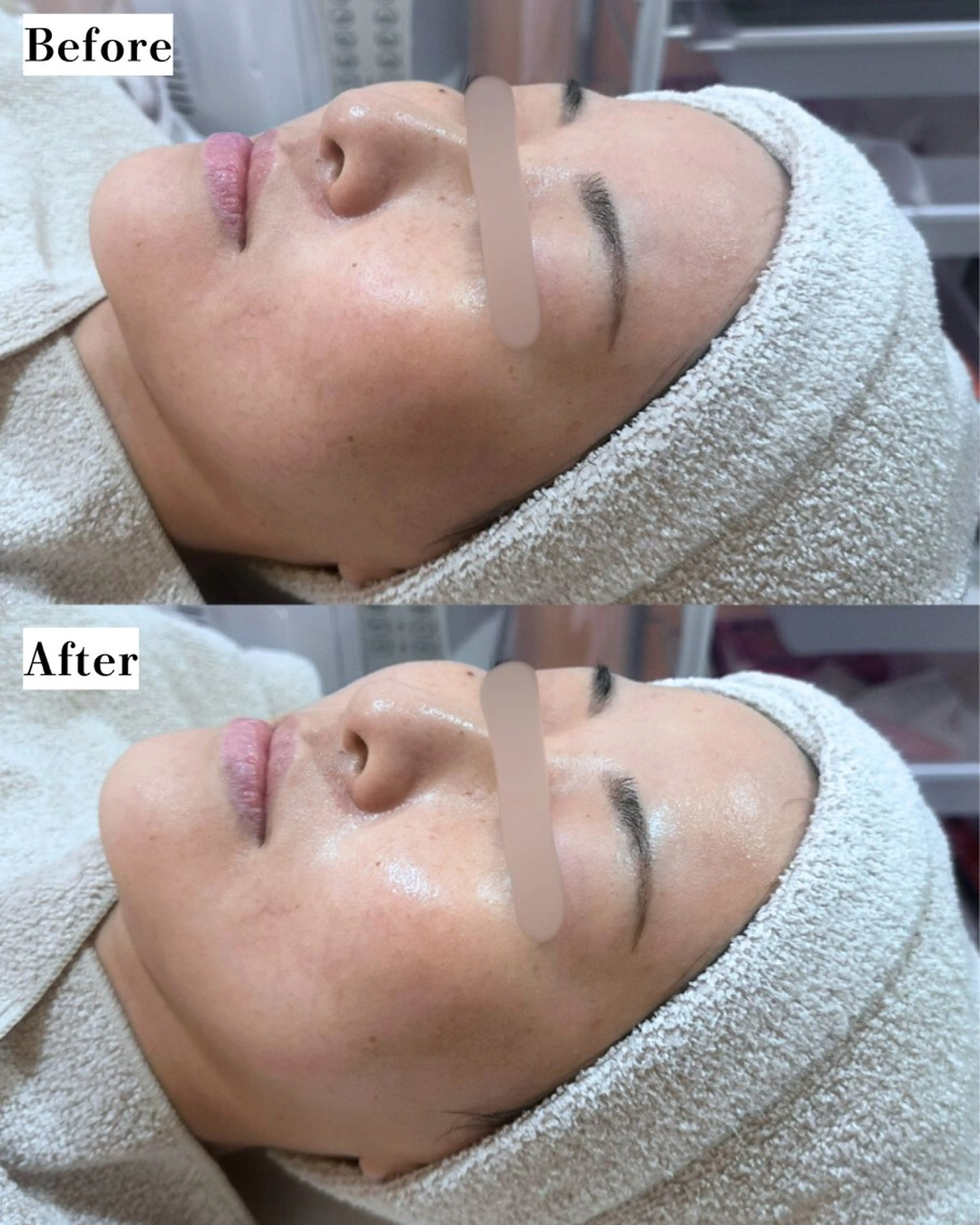 エステ |ピーリング・毛穴| soina神楽坂のエステ・リラクイメージ