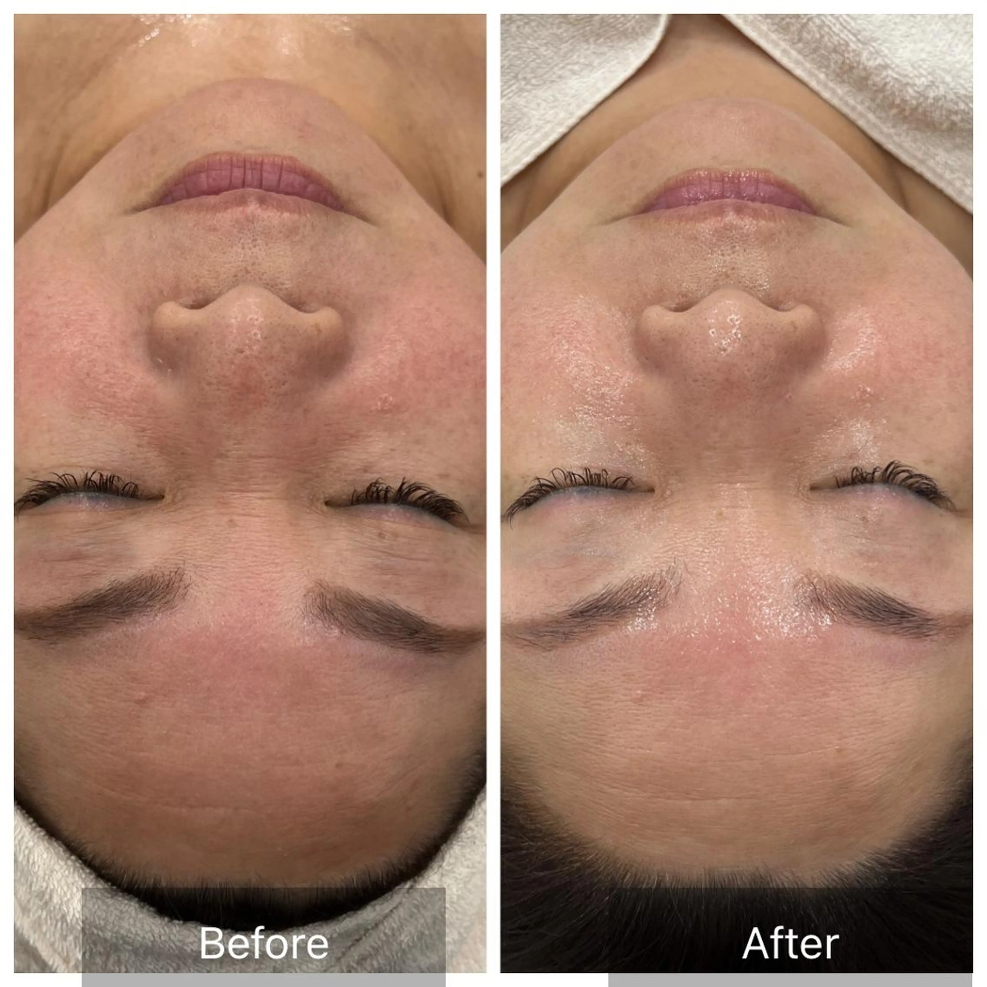 【当店人気NO.１🤳】シワたるみに！ゆるみケアメニュー☺️ヒアルロン酸×コラーゲン×EMSでハリツヤぷるぷる肌🥚の写真