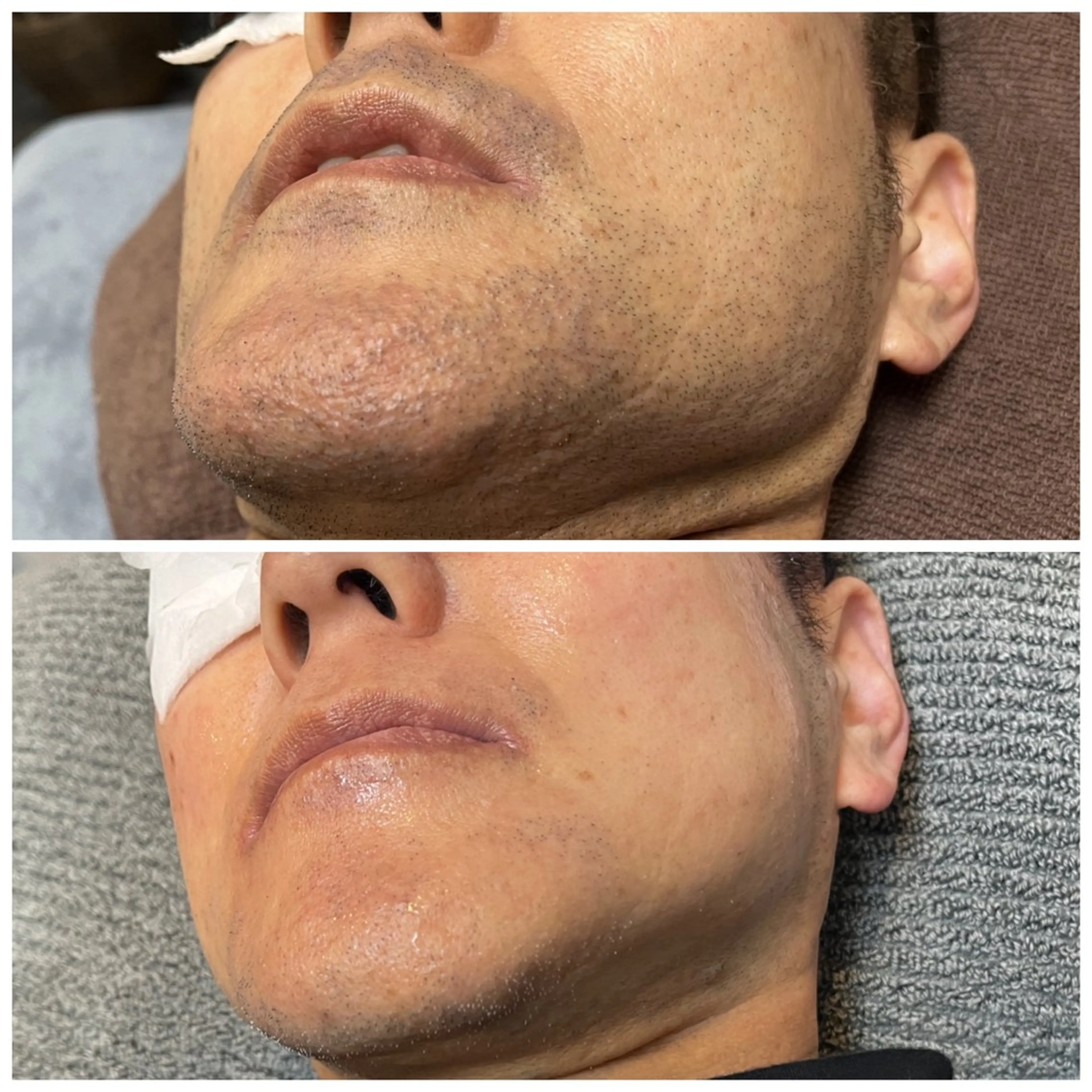 脱毛 epi &... TOTAL BEAUTY所属・epi &... Harukaのエステ・リラクイメージ