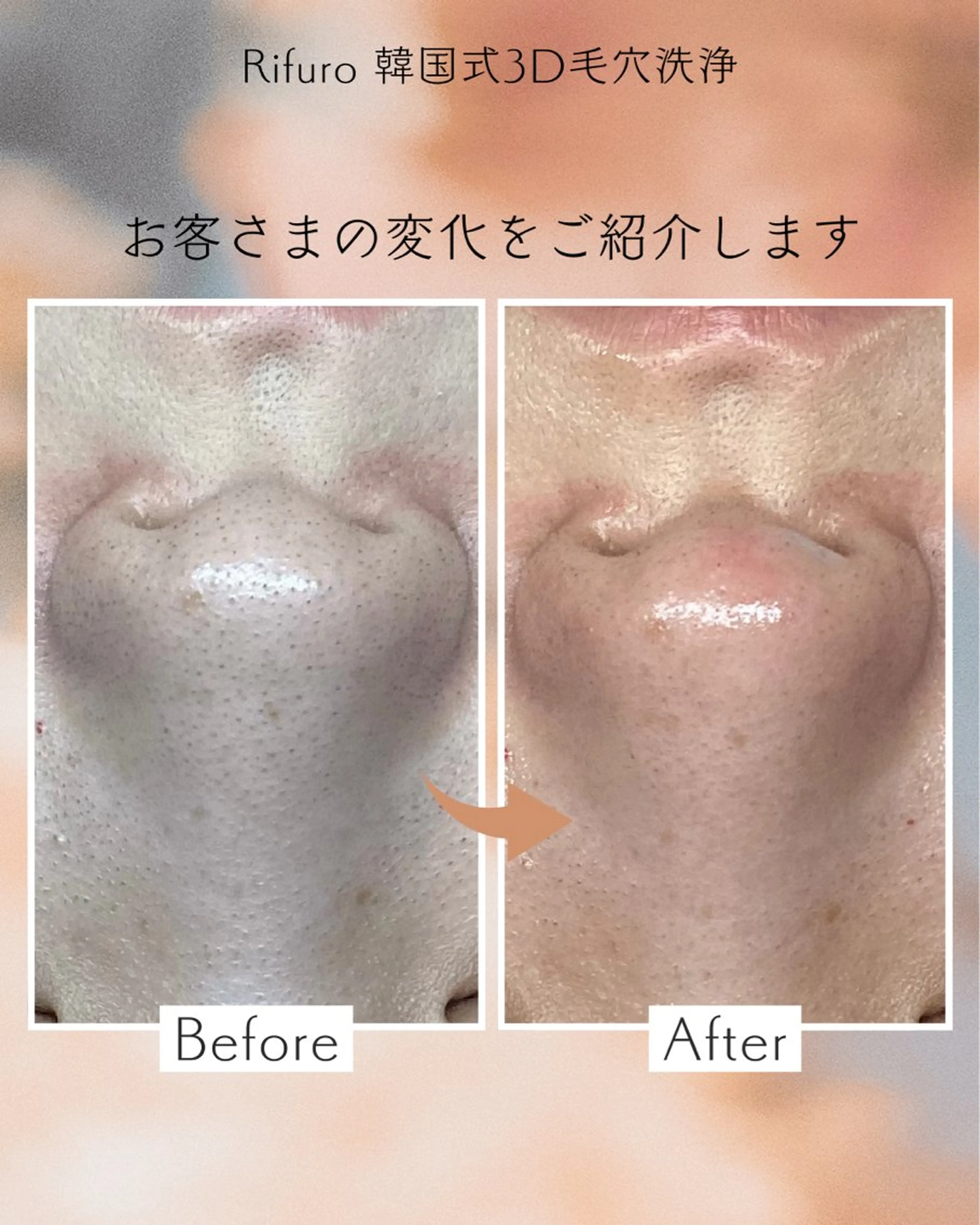 Rifuro 勝田台エステ所属・Rifuro勝田台 ララピール・毛穴洗浄のエステ・リラクイメージ