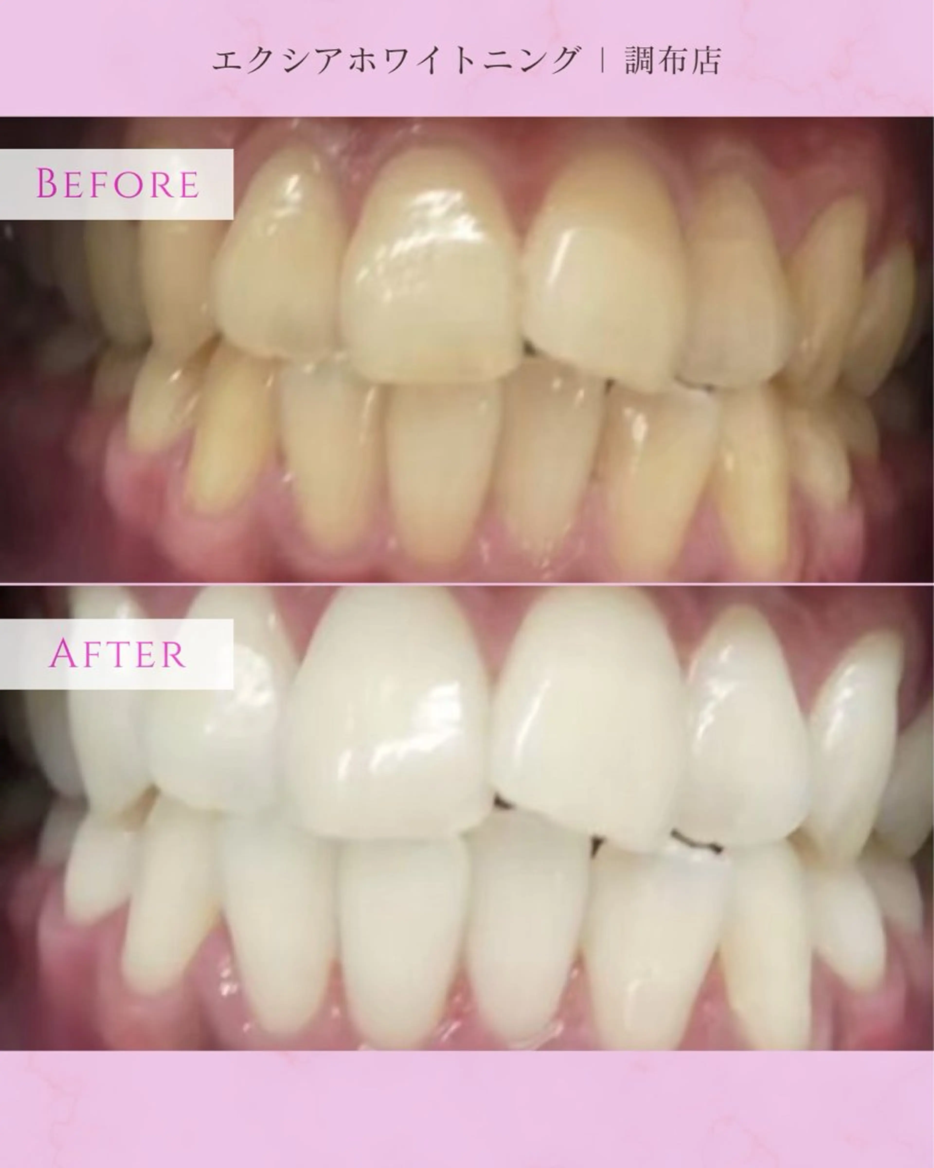 エクシアホワイト調布所属・umi❤︎ ホワイトニングのその他イメージ