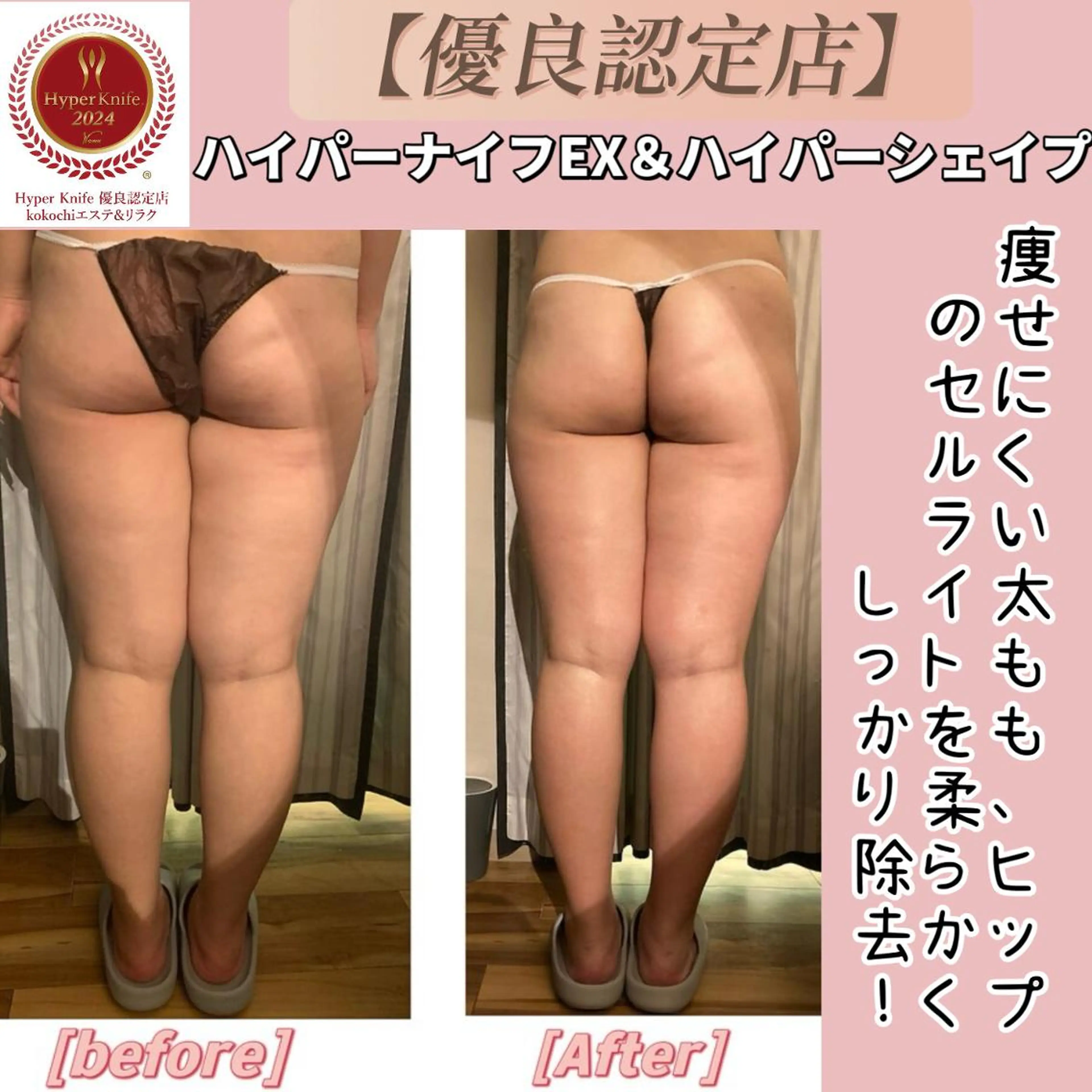 【まずお試し！痩身45分】ハイパーナイフEX＆シェイプ燃焼&強圧リンパ12800→8800の写真