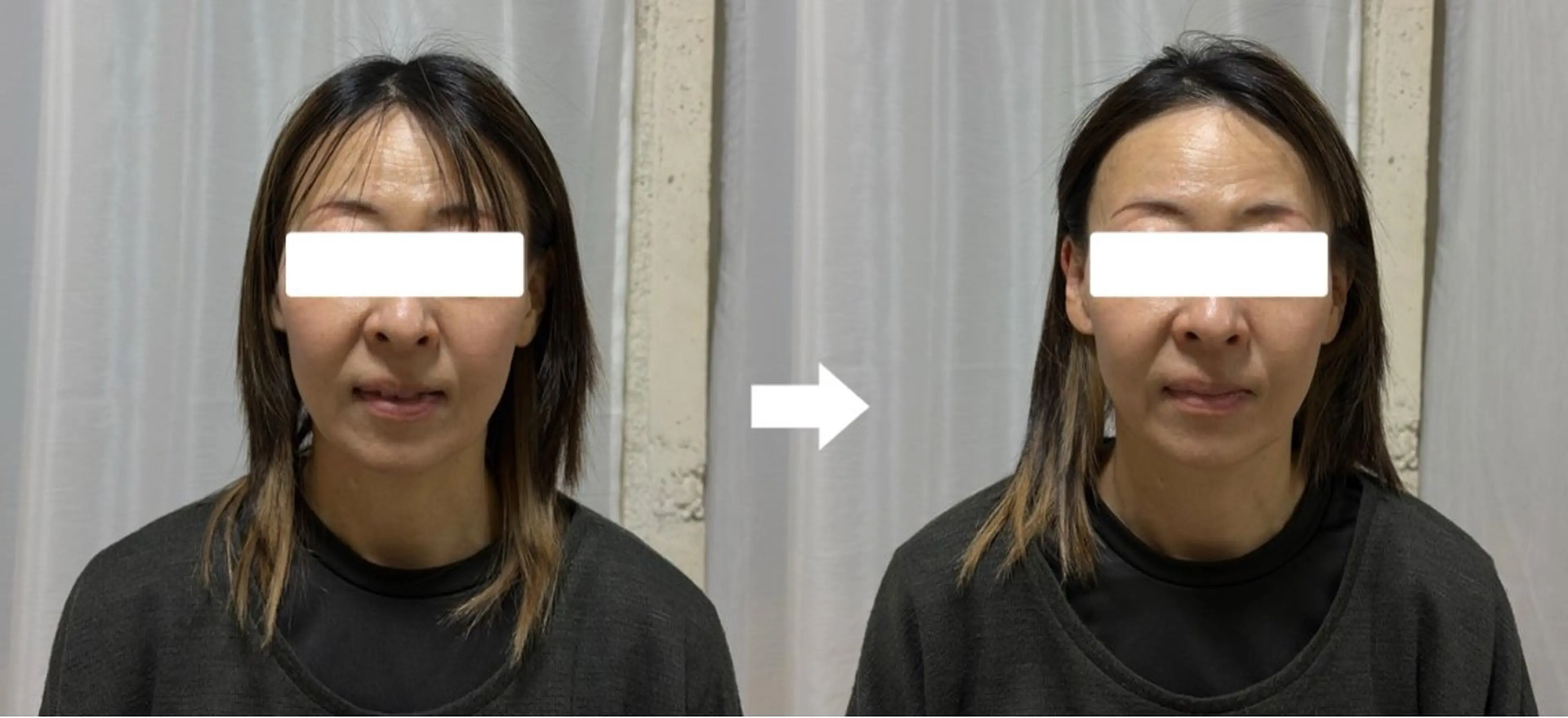 ドライヘッドマッサージ💆‍♀️の写真