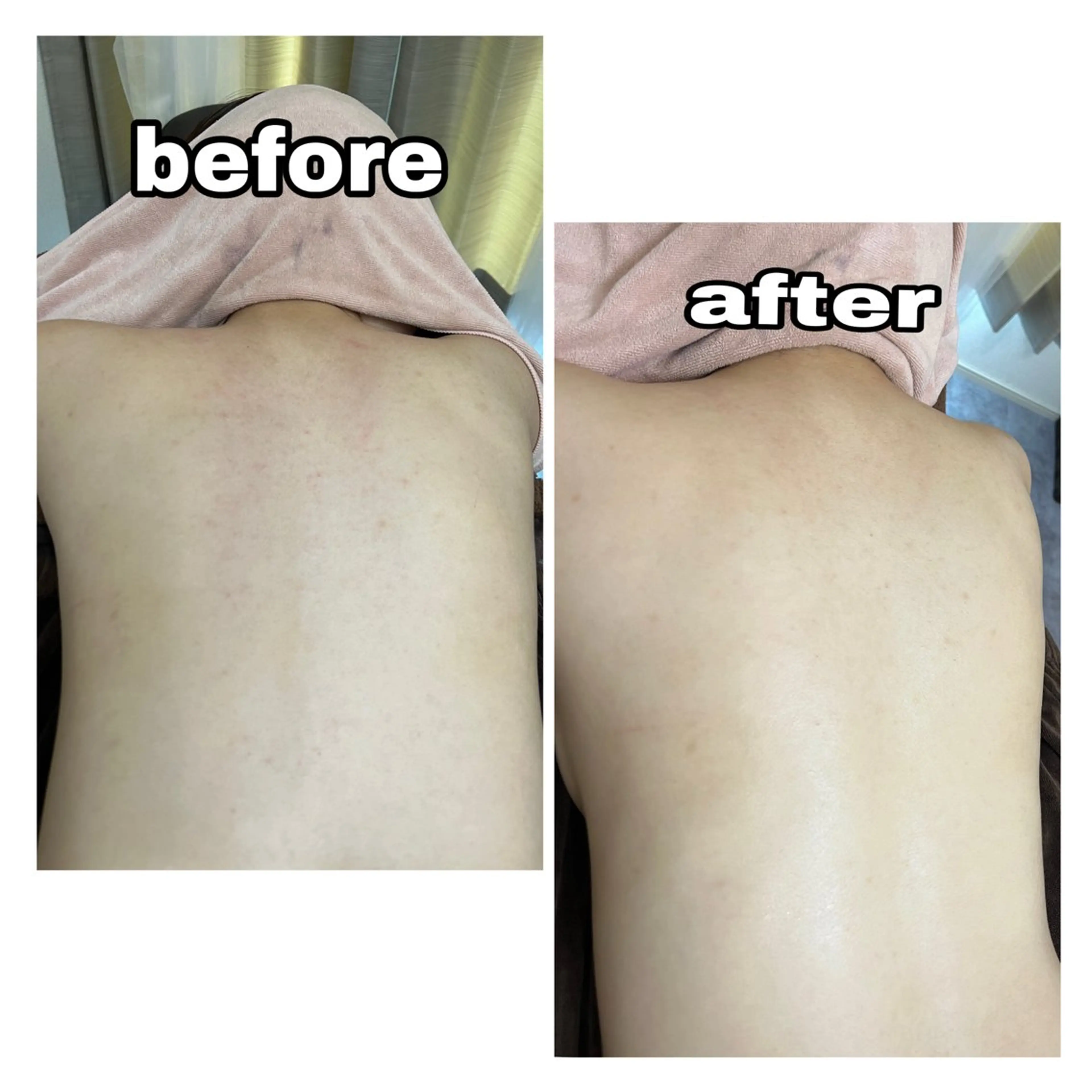 【背中ケア】🩵ྀི     背中ニキビやブライダルに✨の写真