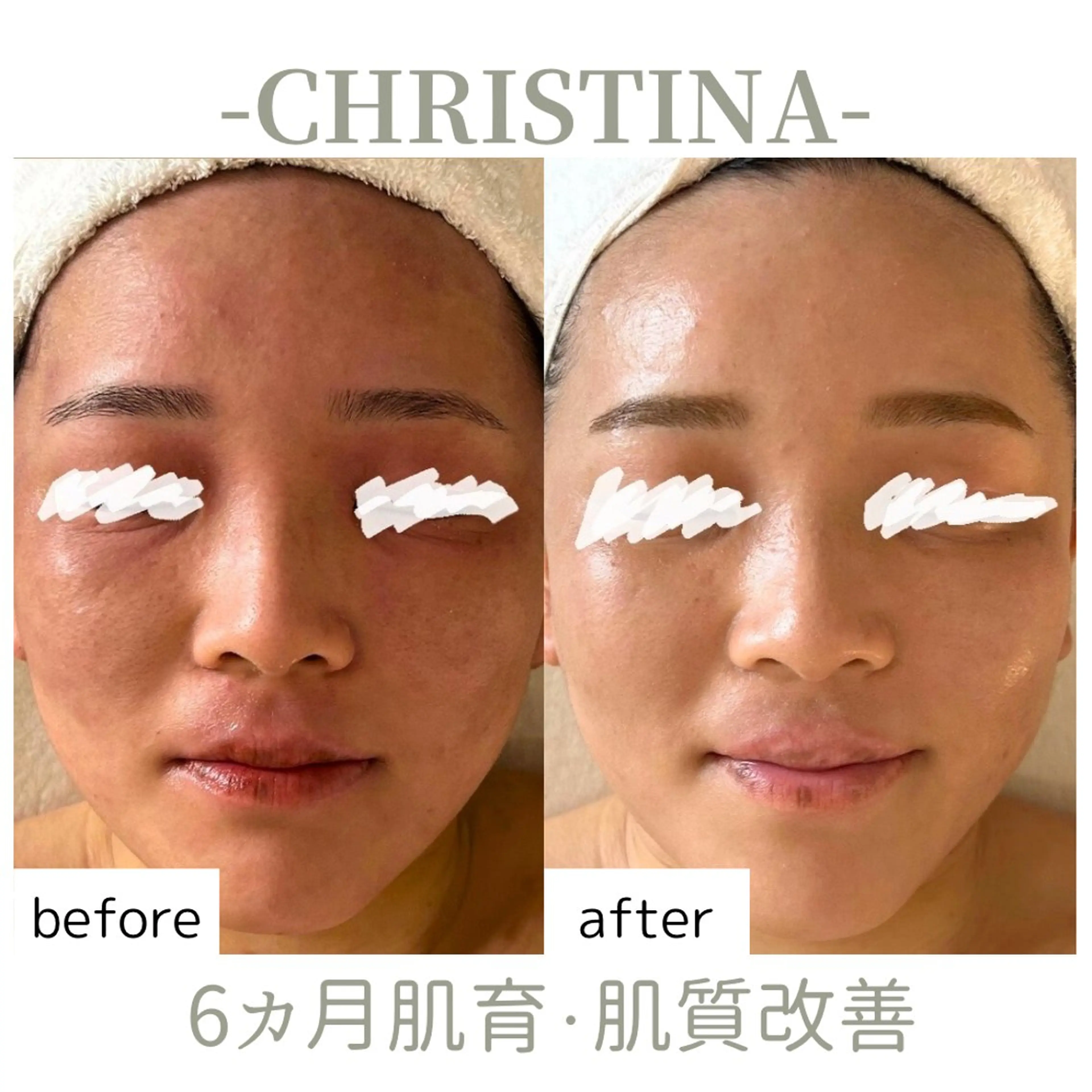 【敏感肌の救世主🕊🩵乳酸菌ピーリング】赤み・乾燥・ゆらぎ肌ケア✦アンストレス|クリスティーナ天王寺・大阪💎の写真