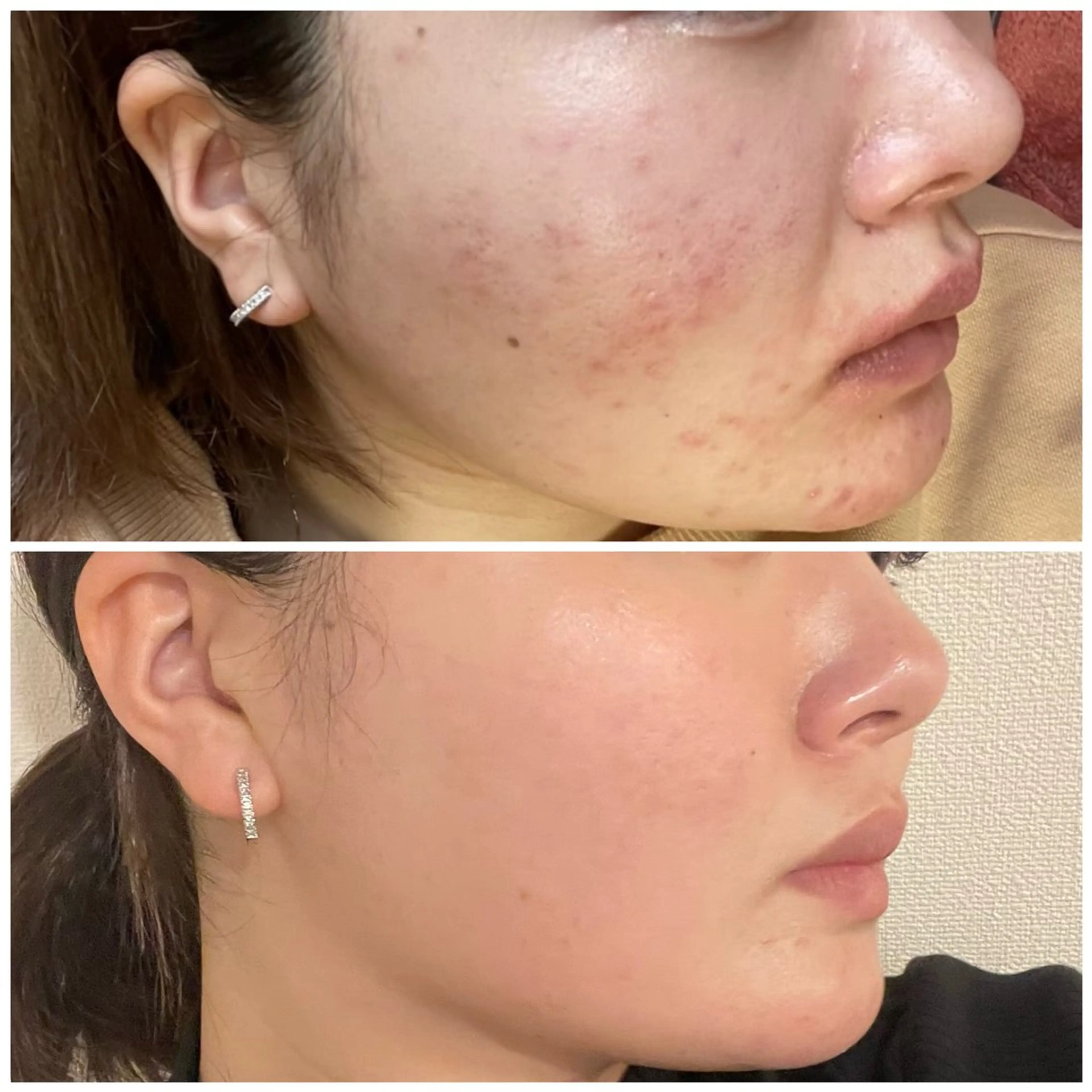 【ニキビや毛穴の開きにお悩みの方必見🍀】光フェイシャル1回体験✨(18歳​〜​29歳限定)の写真