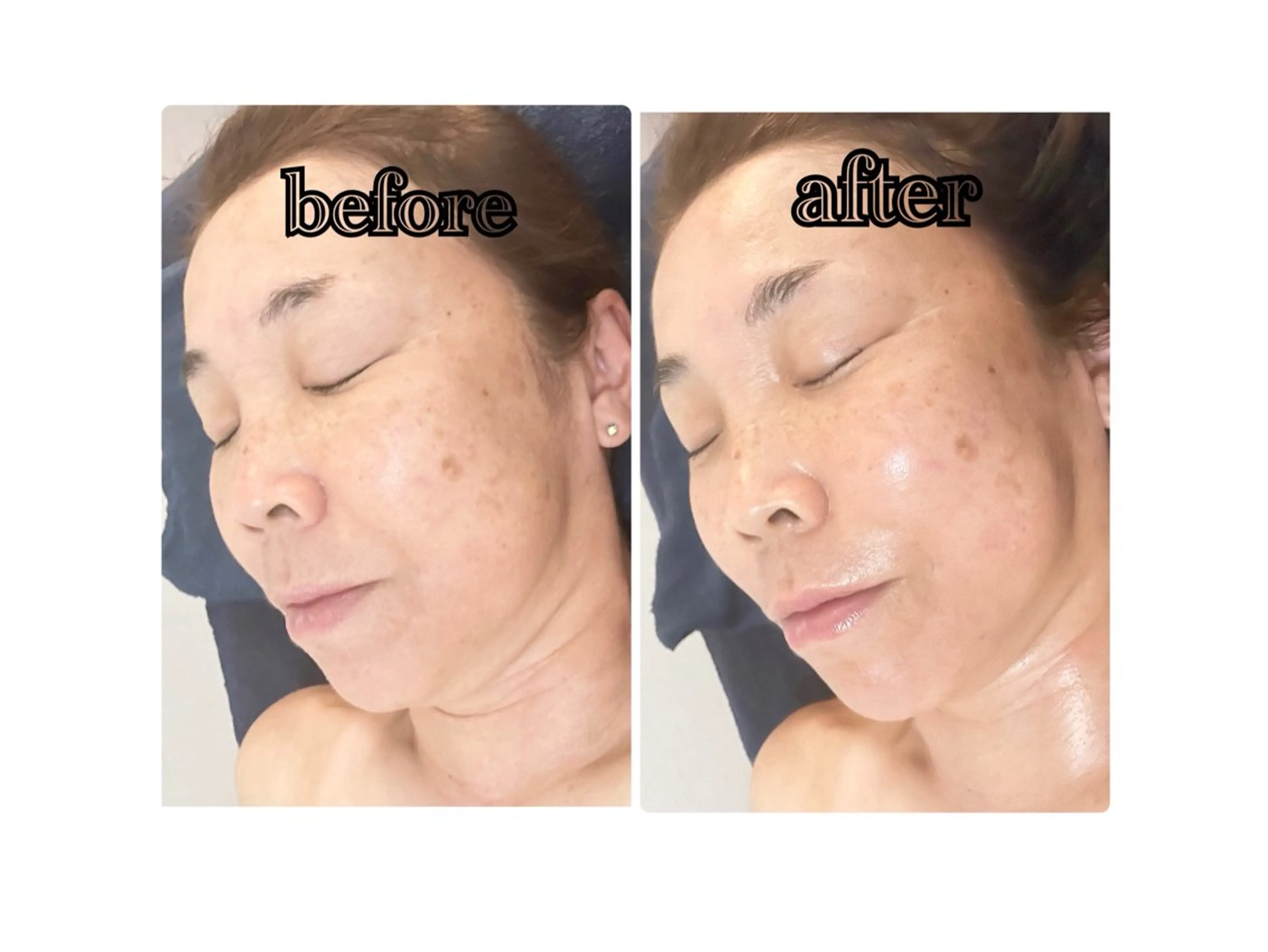 1回でも変化に感動✨【炭酸パックリフトアップフェイシャル】+2stepトリートメント付き45分の写真