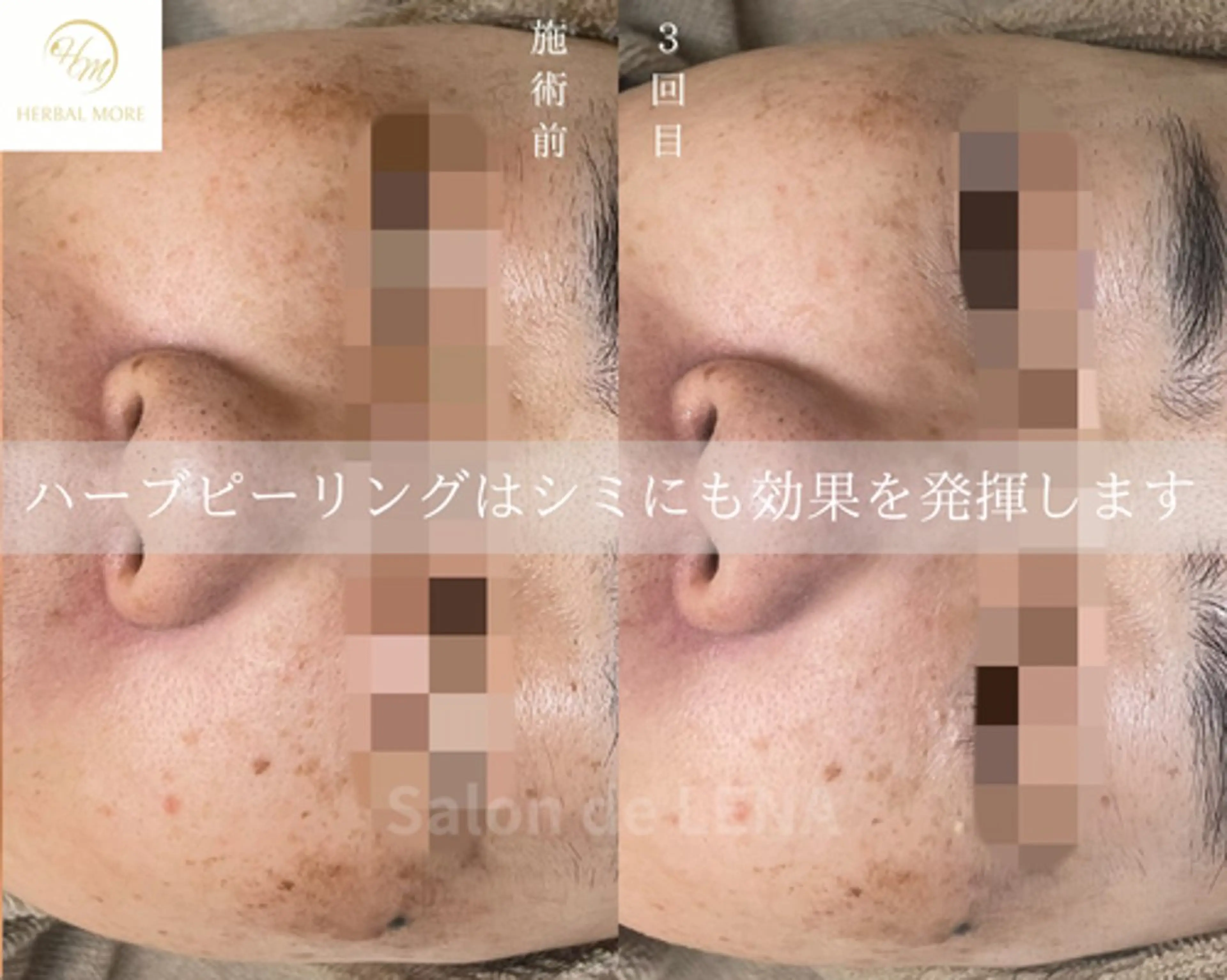 ハーブピーリング・毛穴ケア専門サロンSalon de LENA 栄店所属・ハーブピーリング専門 サロンドレナ　白藤のエステ・リラクイメージ