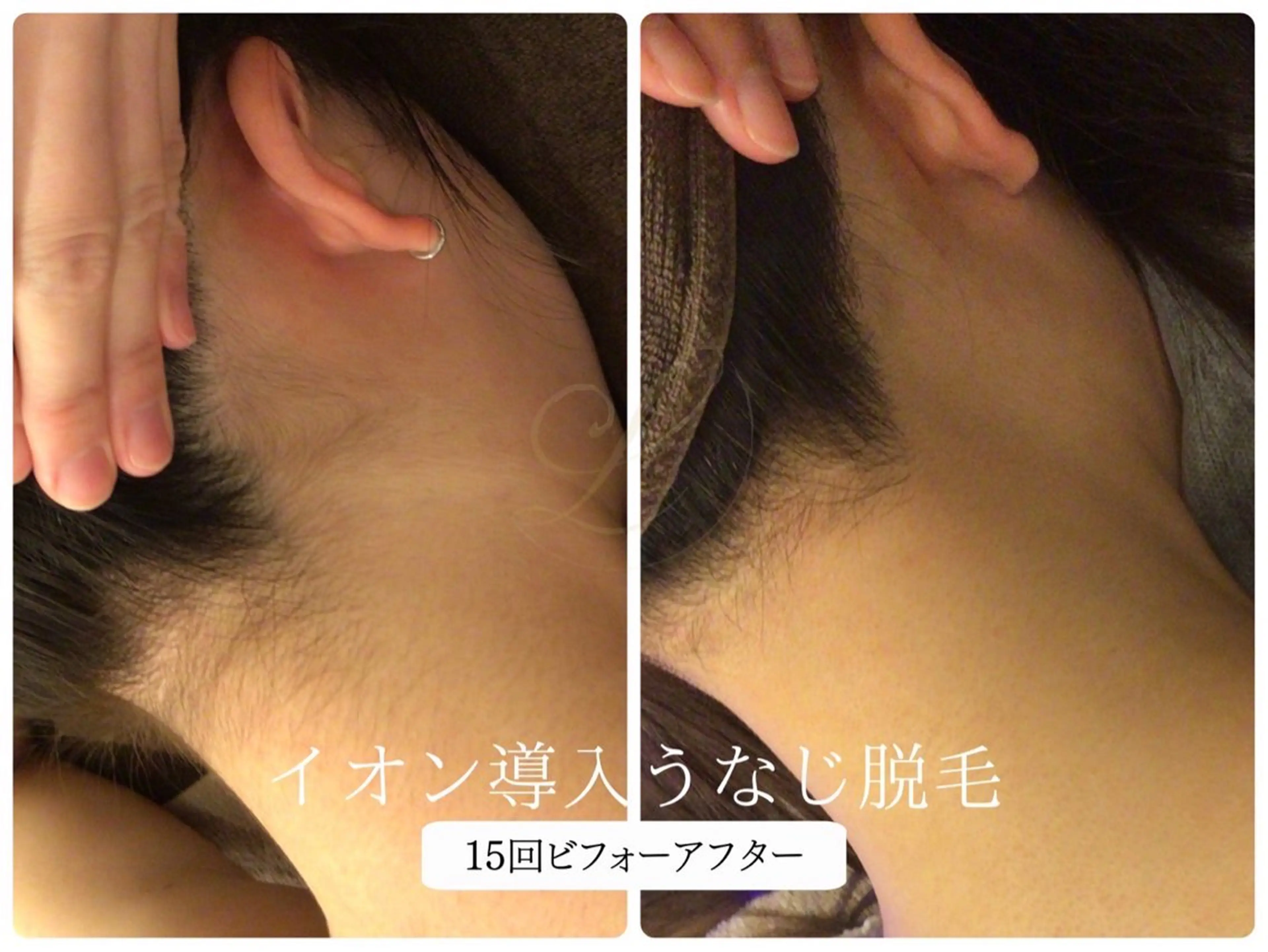 脱毛 Beauty  salon Lino所属・🎀うなじ脱毛🎀 ㅣLino堀江のエステ・リラクイメージ