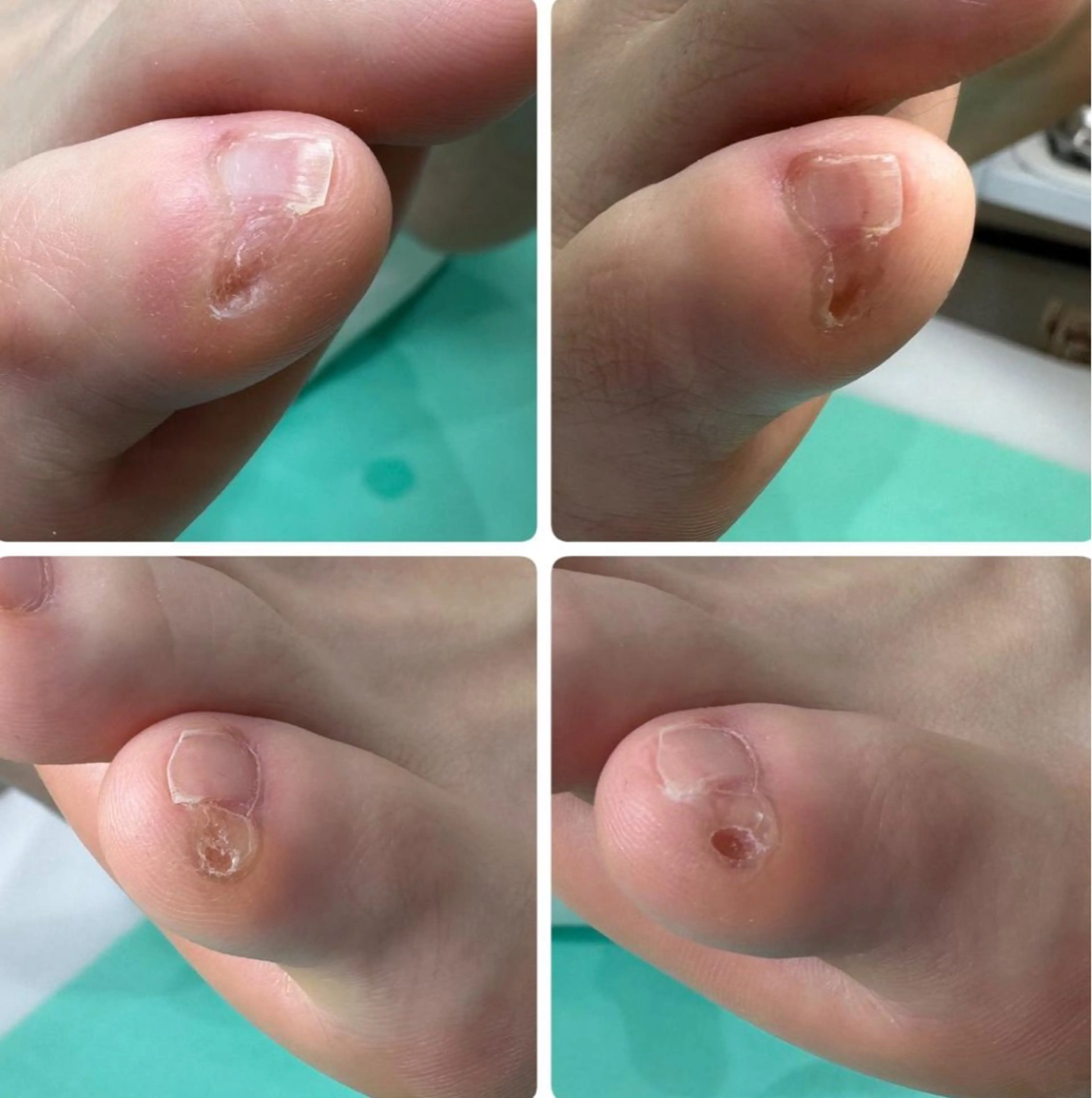 【副爪2カ所】小指横の小さな爪…実はかた​〜​い角質です😳‼️綺麗に除去して痛みや違和感もスッキリ✨しましょの写真