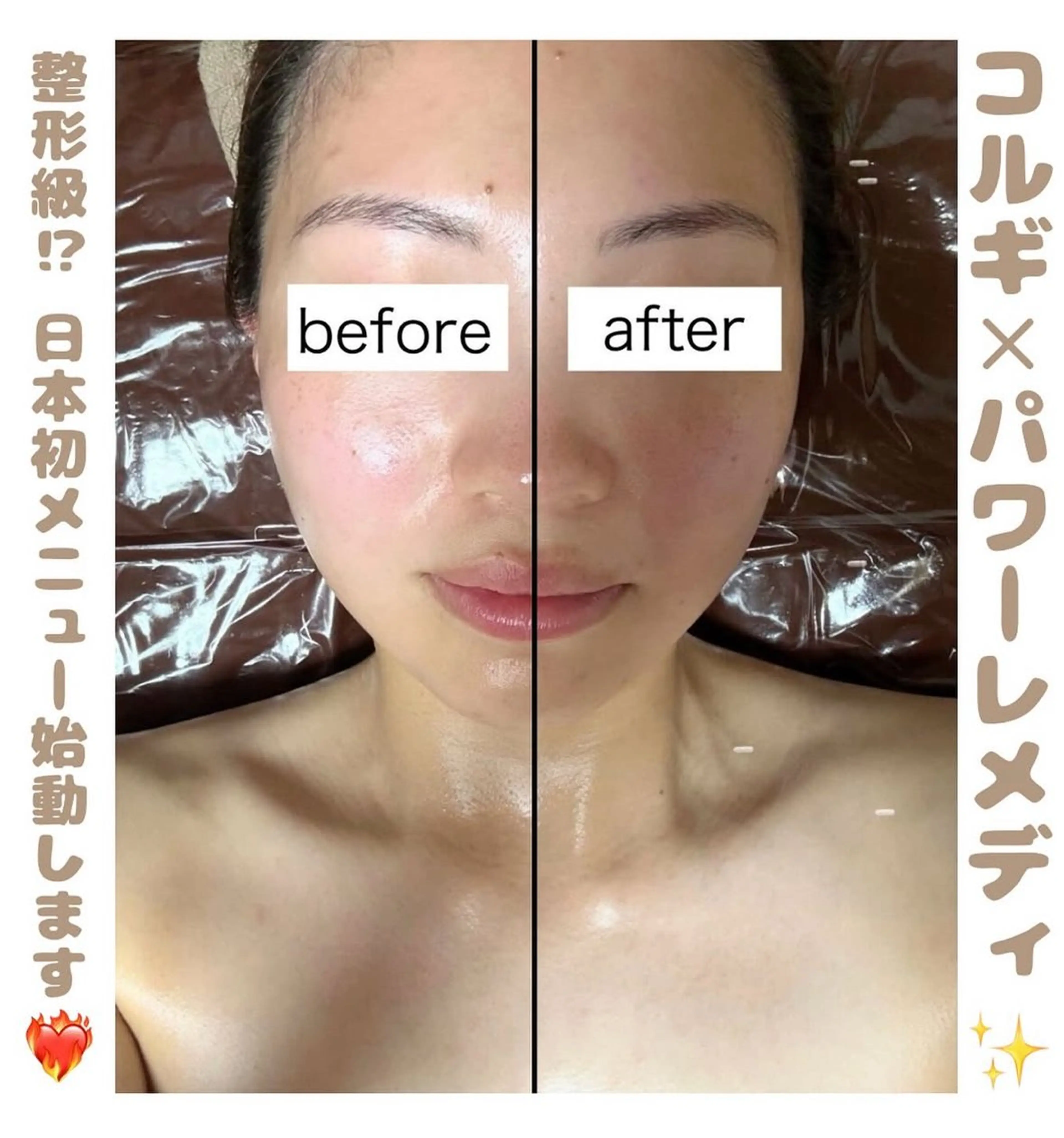 【日本初導入❤️🔥】コルギ×パワーレメディで3D小顔矯正💆🏻♀️✨速攻で整形級の変化に🥹の写真