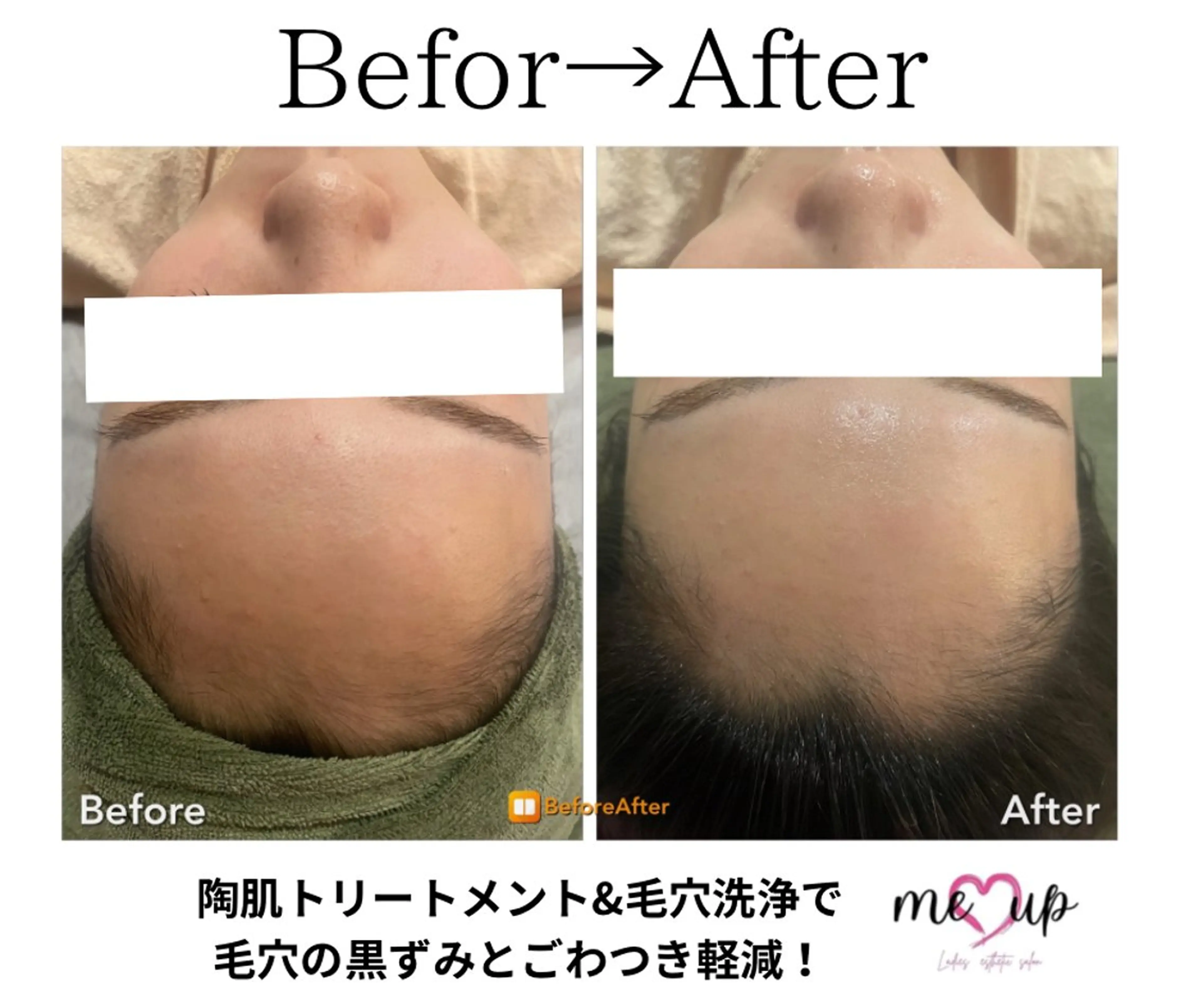 Meupニキビ専門店 背中/ハーブ/肌管理のその他イメージ