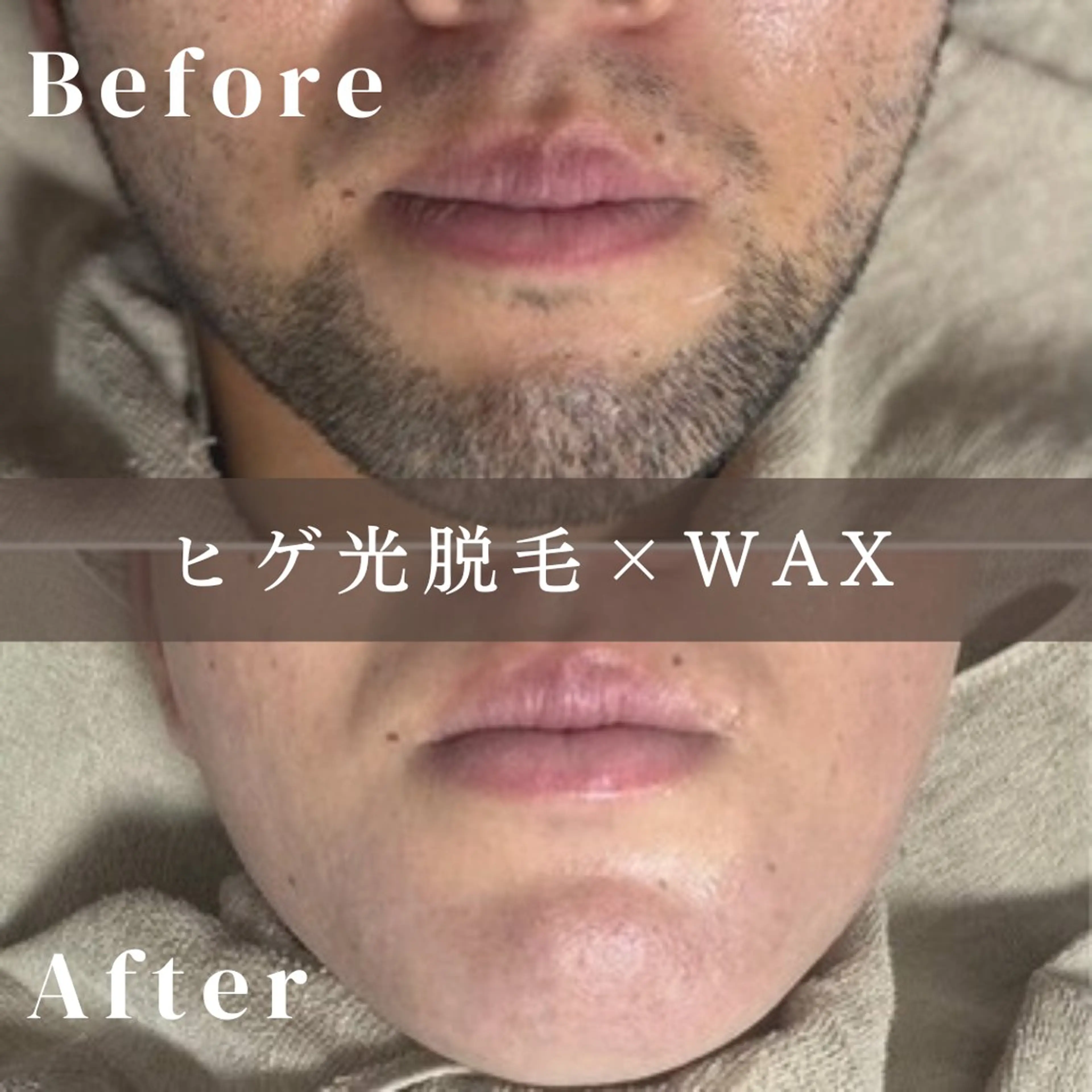 【ヒゲMIX脱毛】¥15,000→¥6,000 目指せ青髭卒業👨🏻の写真